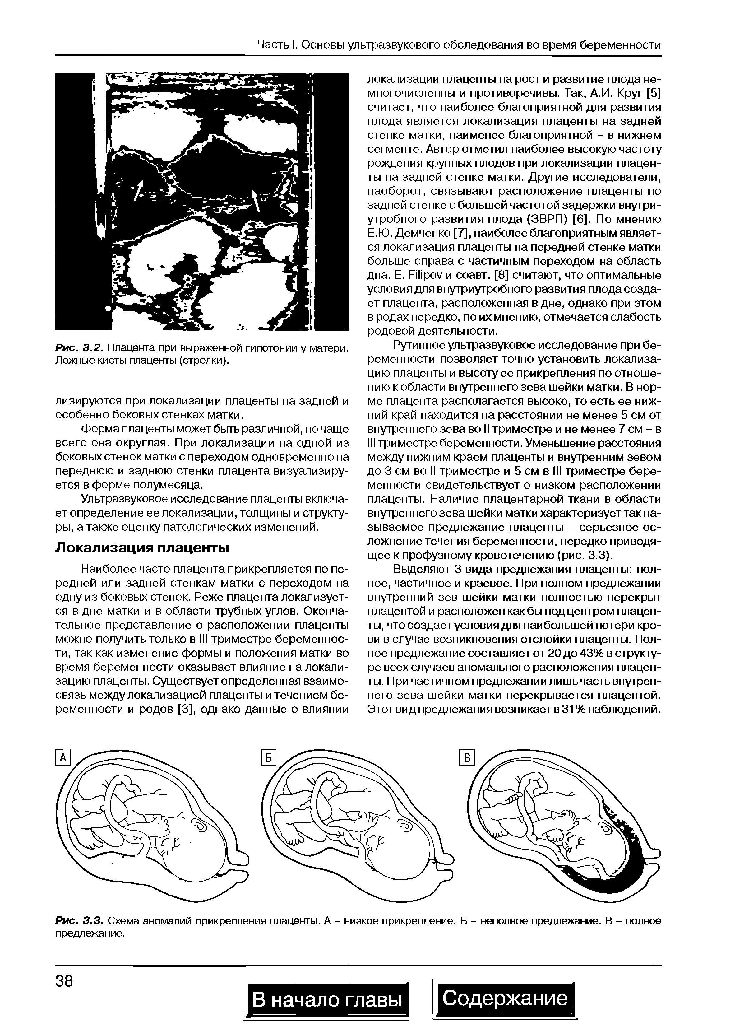 Рис. 3.3. Схема аномалий прикрепления плаценты. А - низкое прикрепление. Б - неполное предлежание. В - полное предлежание.