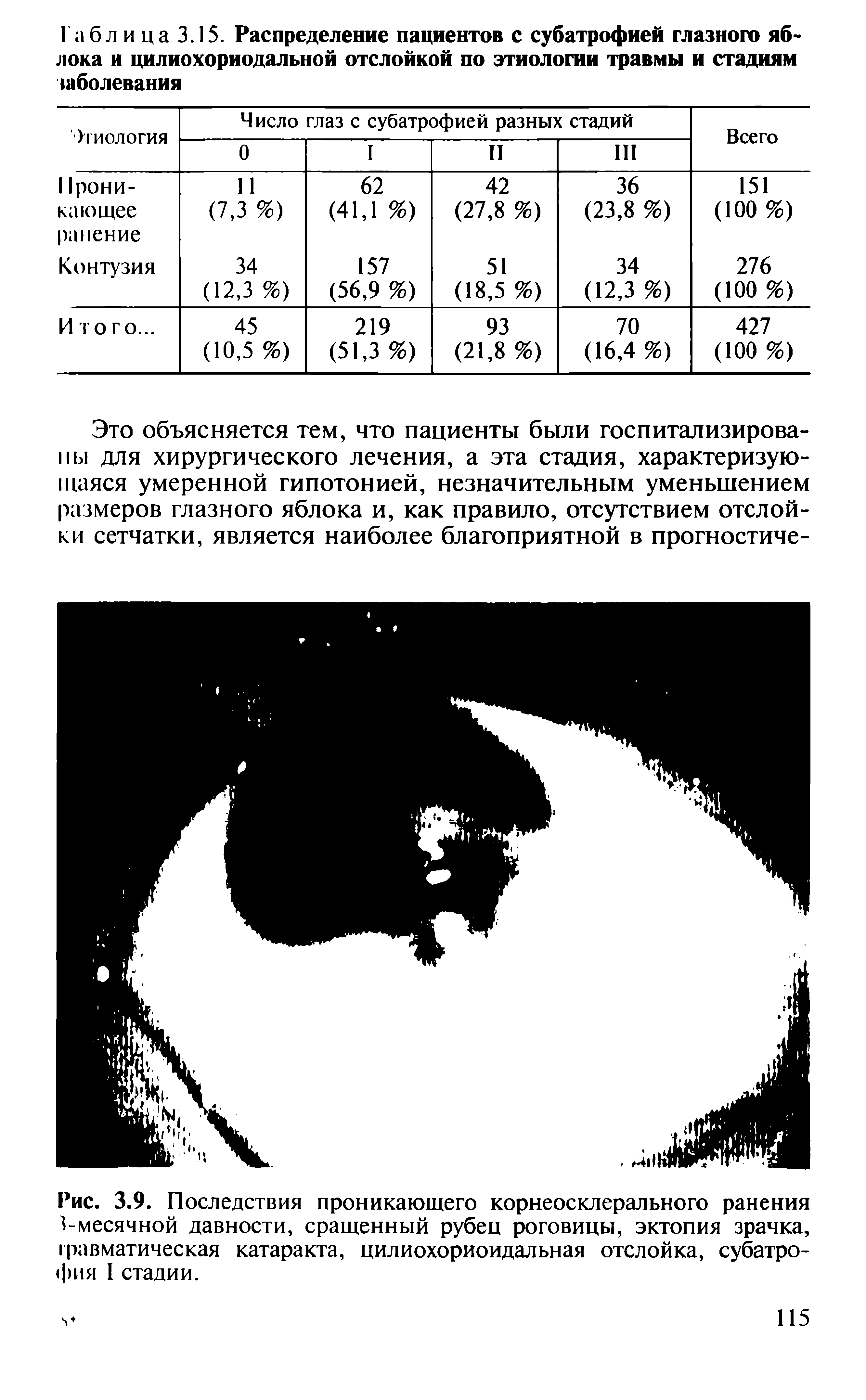 Рис. 3.9. Последствия проникающего корнеосклерального ранения месячной давности, сращенный рубец роговицы, эктопия зрачка, травматическая катаракта, цилиохориоидальная отслойка, субатрофия I стадии.