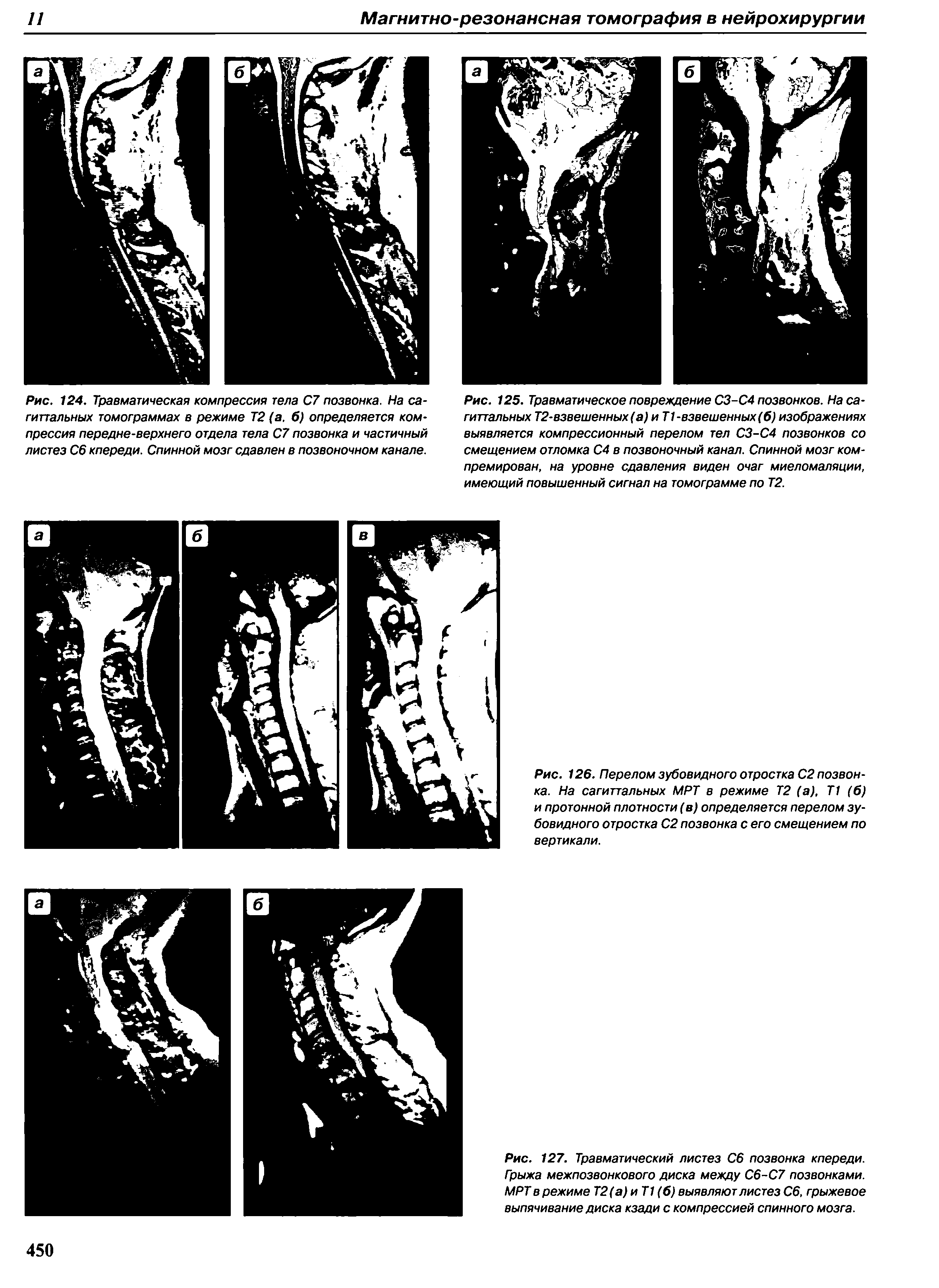Рис. 125. Травматическое повреждение СЗ-С4 позвонков. На сагиттальных Т2-взвешенных(а) и Т1-взвешенных (6) изображениях выявляется компрессионный перелом тел СЗ-С4 позвонков со смещением отломка С4 в позвоночный канал. Спинной мозг ком-премирован, на уровне сдавления виден очаг миеломаляции, имеющий повышенный сигнал на томограмме по Т2.
