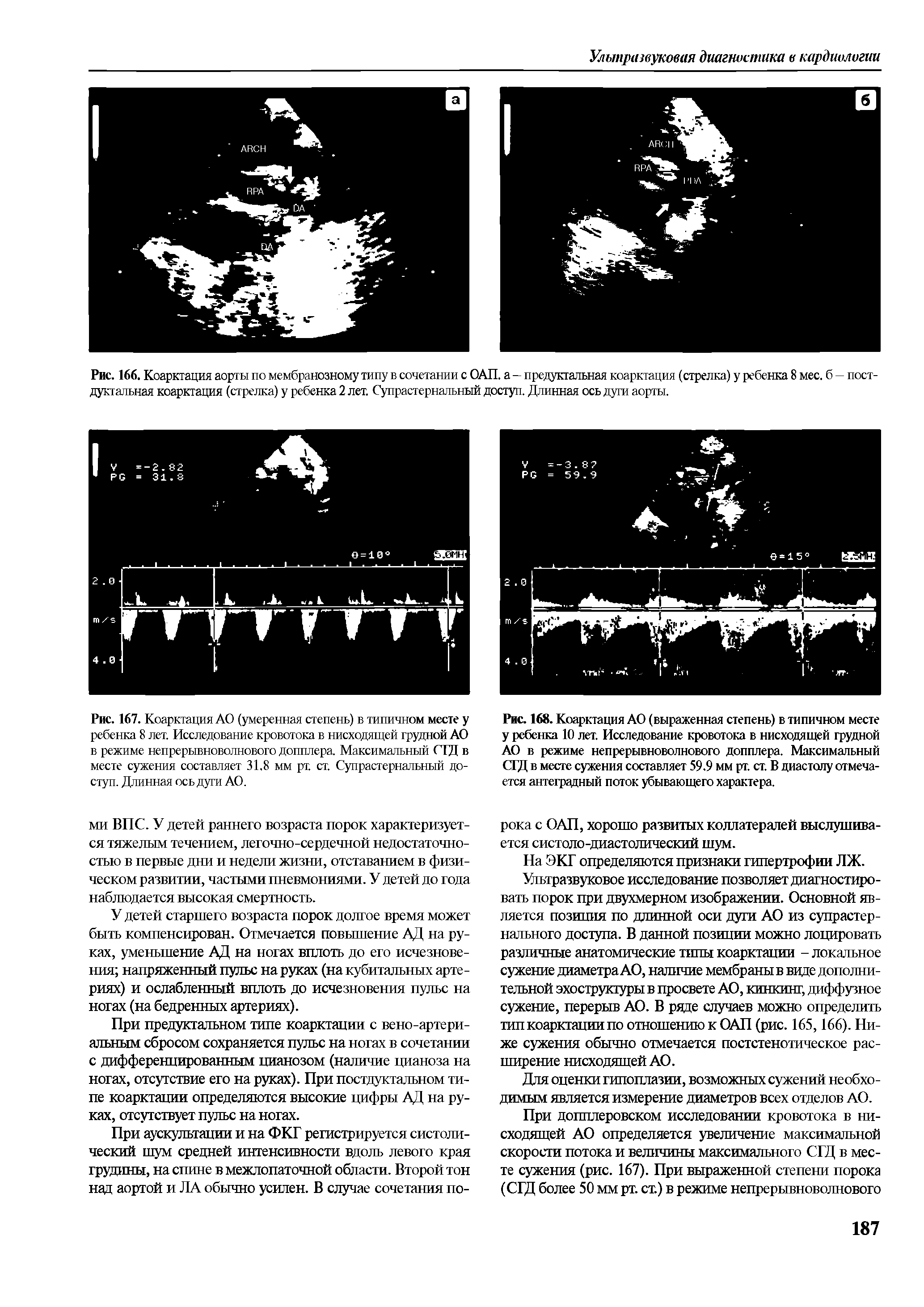 Рис. 167. Коарктация АО (умеренная степень) в типичном месте у ребенка 8 лет. Исследование кровотока в нисходящей грудной АО в режиме непрерывноволнового допплера. Максимальный СГД в месте сужения составляет 31.8 мм рт. ст. Супрастернальный доступ. Длинная ось дуги АО.