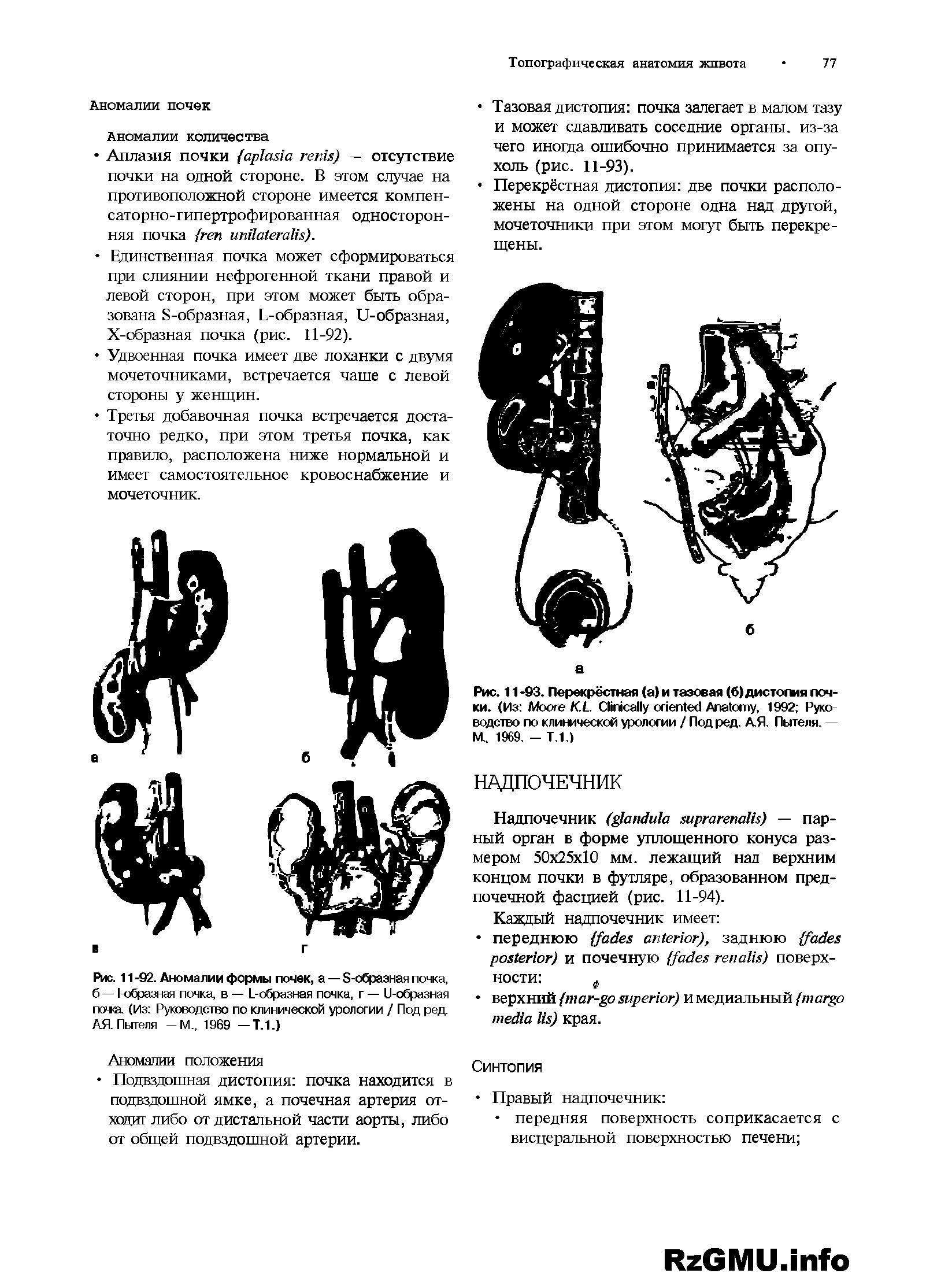 Рис. 11 -93. Перекрёстная (а) и тазовая (б) дистогшя почки. (Из M K.L C A , 1992 Руководство по клинической урологии / Под ред. АЯ. Пытеля. — М.. 1969. - Т.1.)...