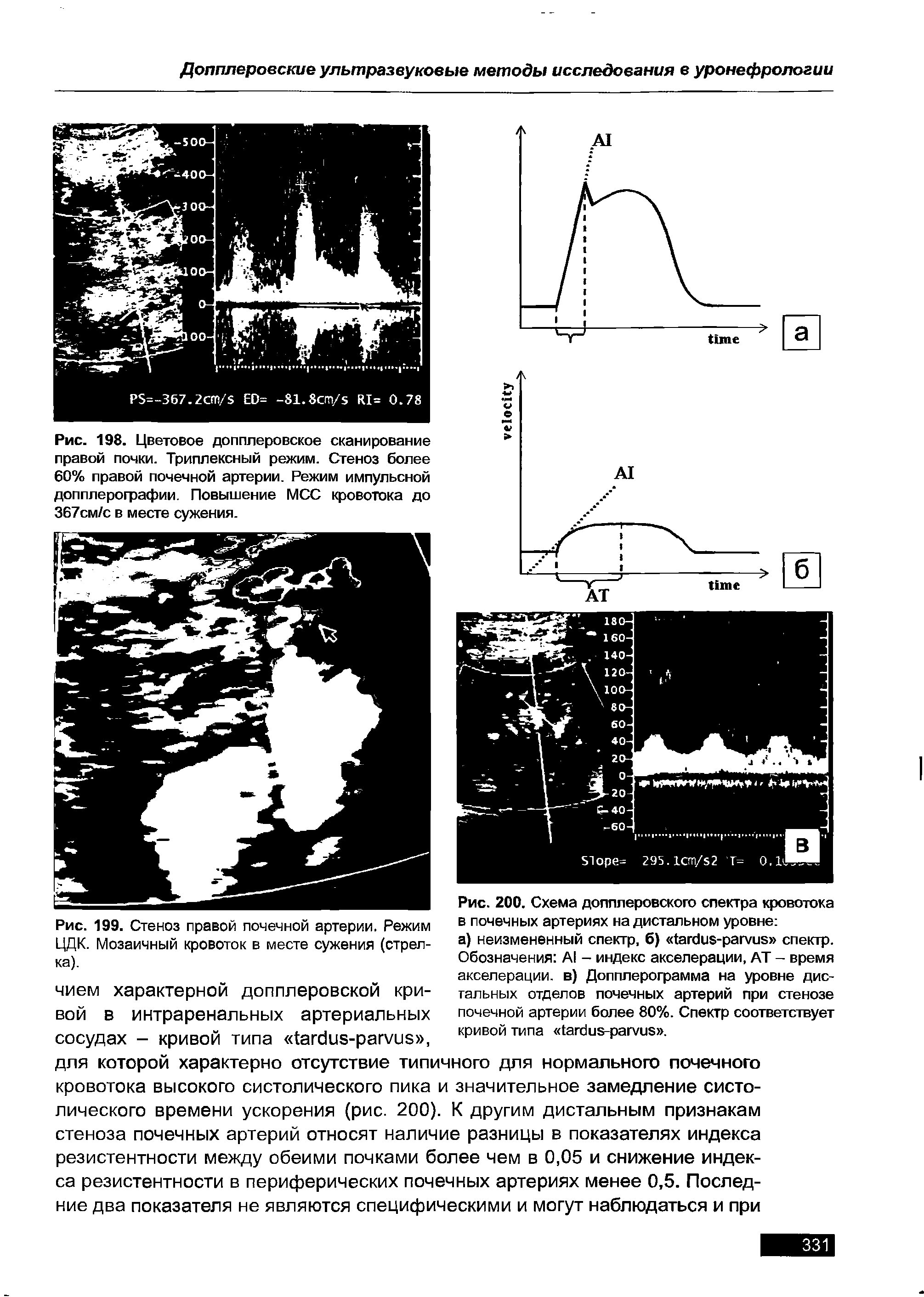 Рис. 198. Цветовое допплеровское сканирование правой почки. Триплексный режим. Стеноз более 60% правой почечной артерии. Режим импульсной допплерографии. Повышение МСС кровотока до 367см/с в месте сужения.