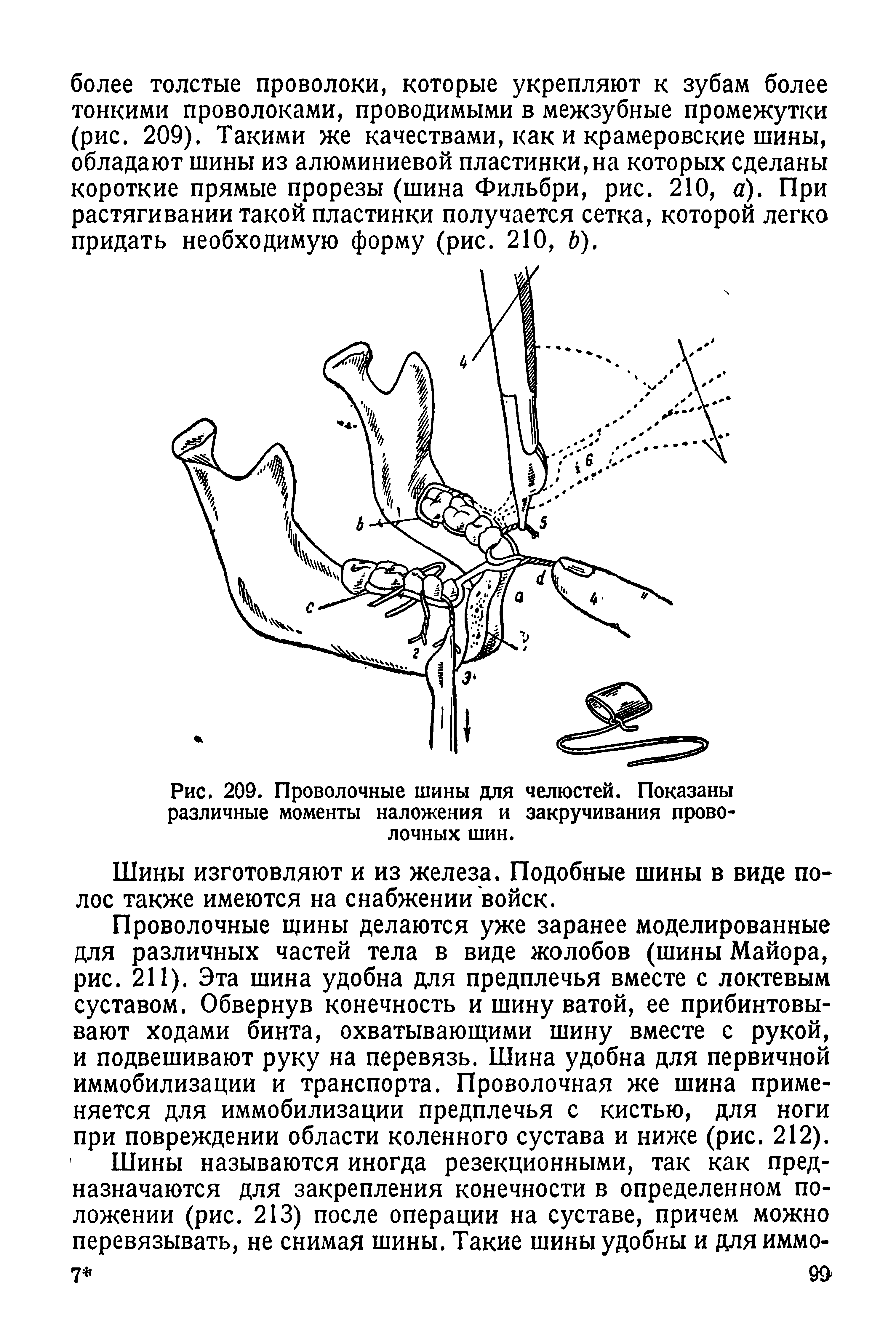 Рис. 209. Проволочные шины для челюстей. Показаны различные моменты наложения и закручивания проволочных шин.