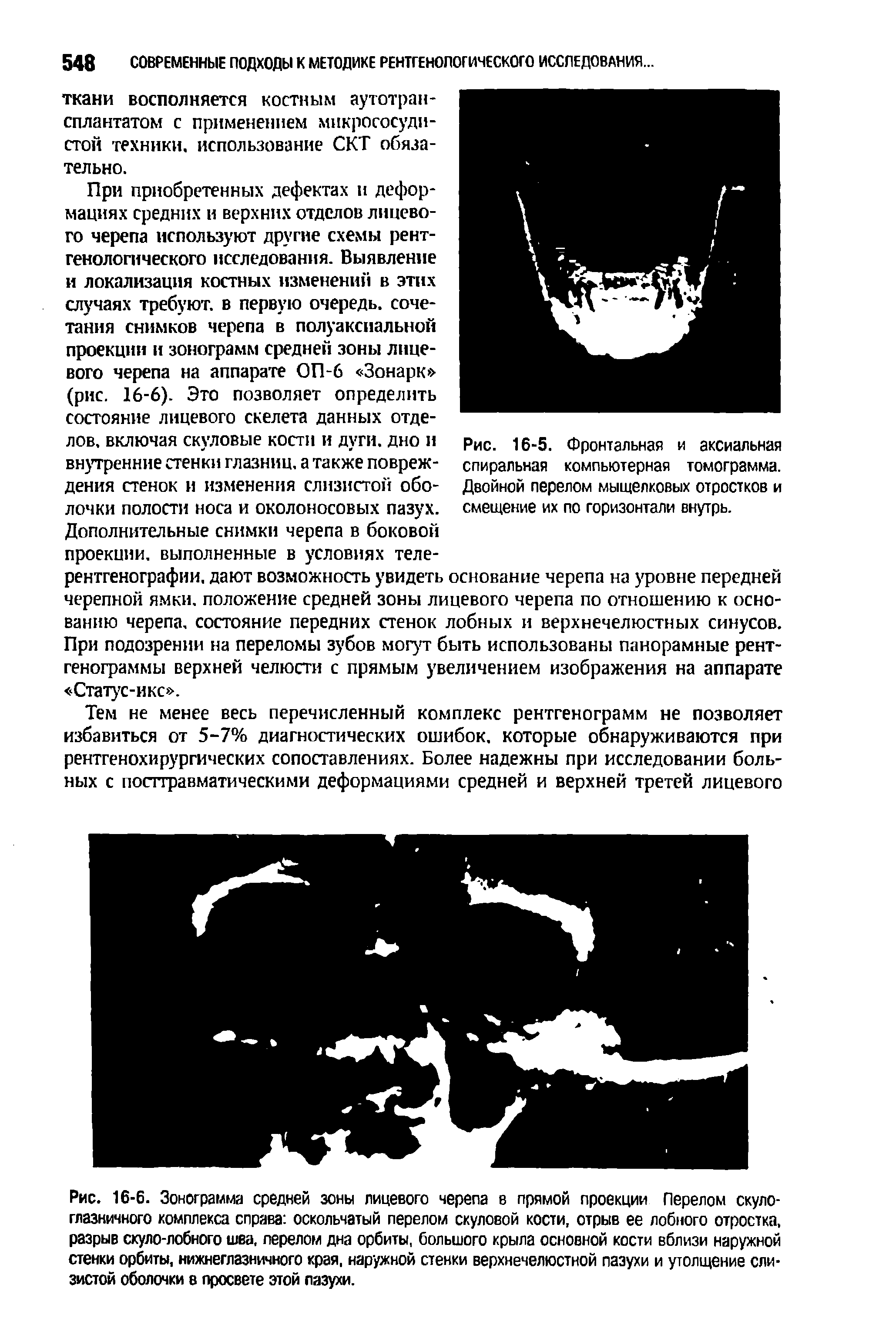 Рис. 16-5. Фронтальная и аксиальная спиральная компьютерная томограмма. Двойной перелом мыщелковых отростков и смещение их по горизонтали внутрь.