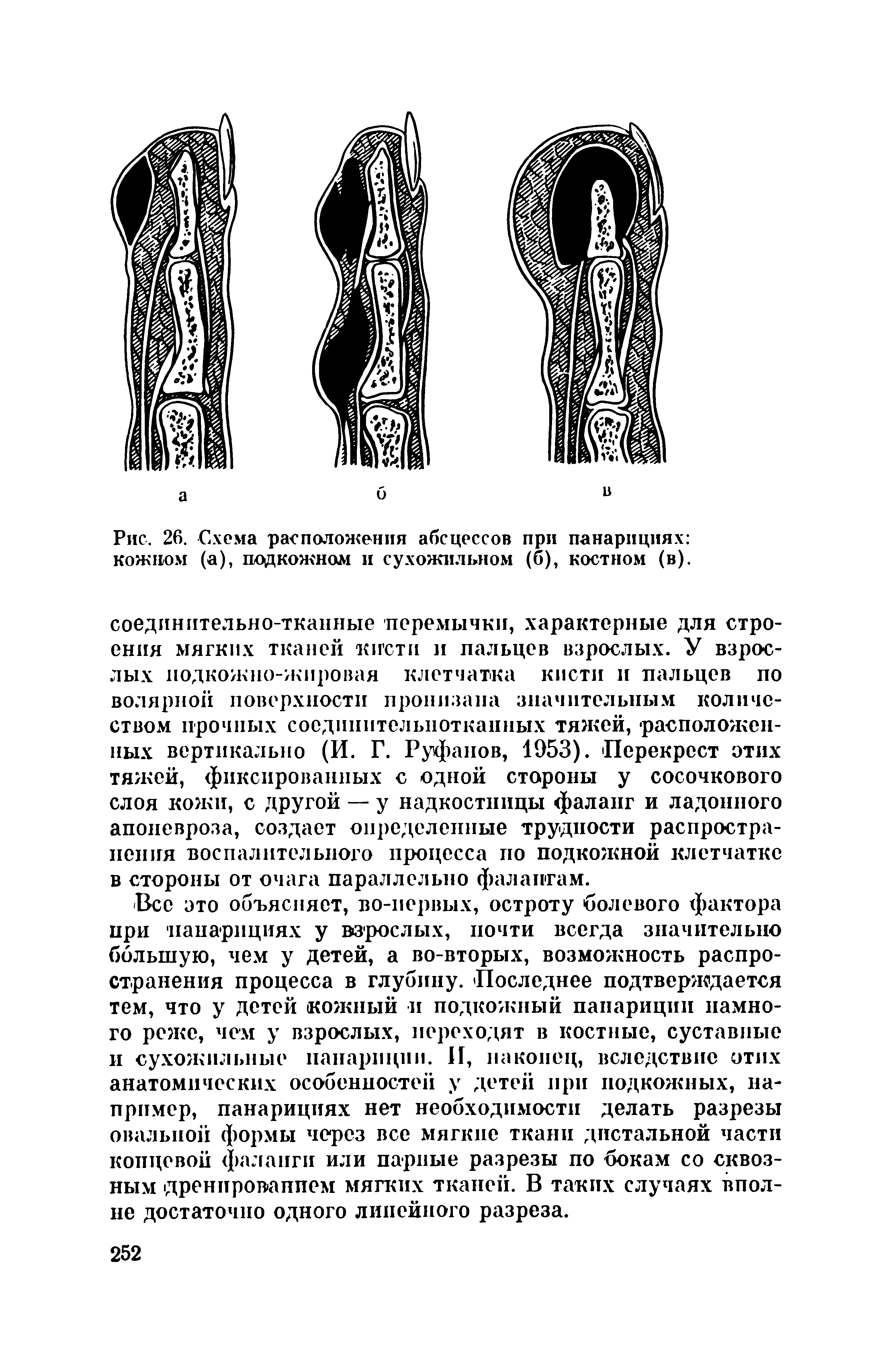 Рис. 26. Схема расположения абсцессов при панарициях кожном (а), подкожном и сухожильном (б), костном (в).