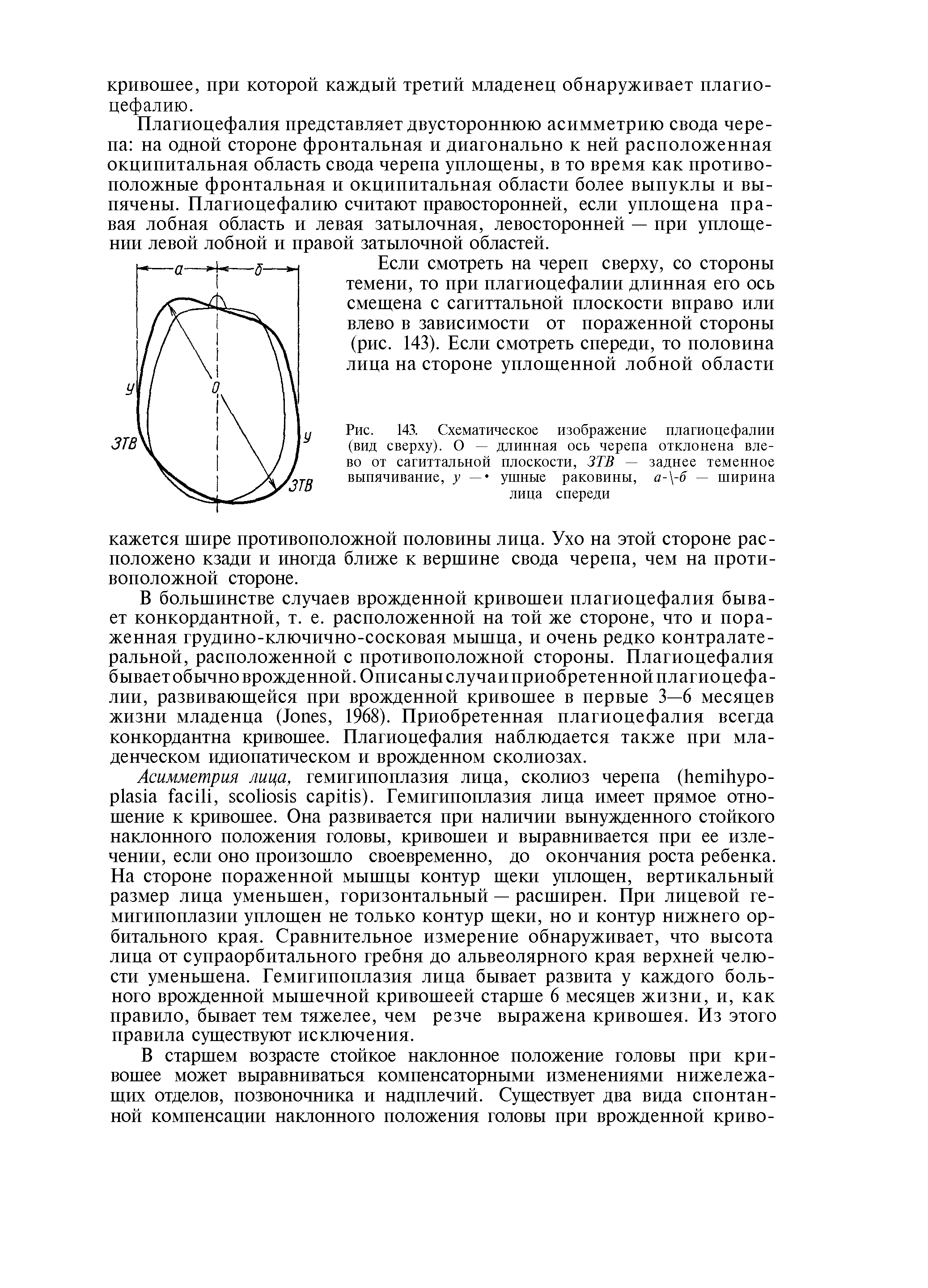 Рис. 143. Схематическое изображение плагиоцефалии (вид сверху). О — длинная ось черепа отклонена влево от сагиттальной плоскости, ЗТВ — заднее теменное выпячивание, у — ушные раковины, а- -б — ширина лица спереди...