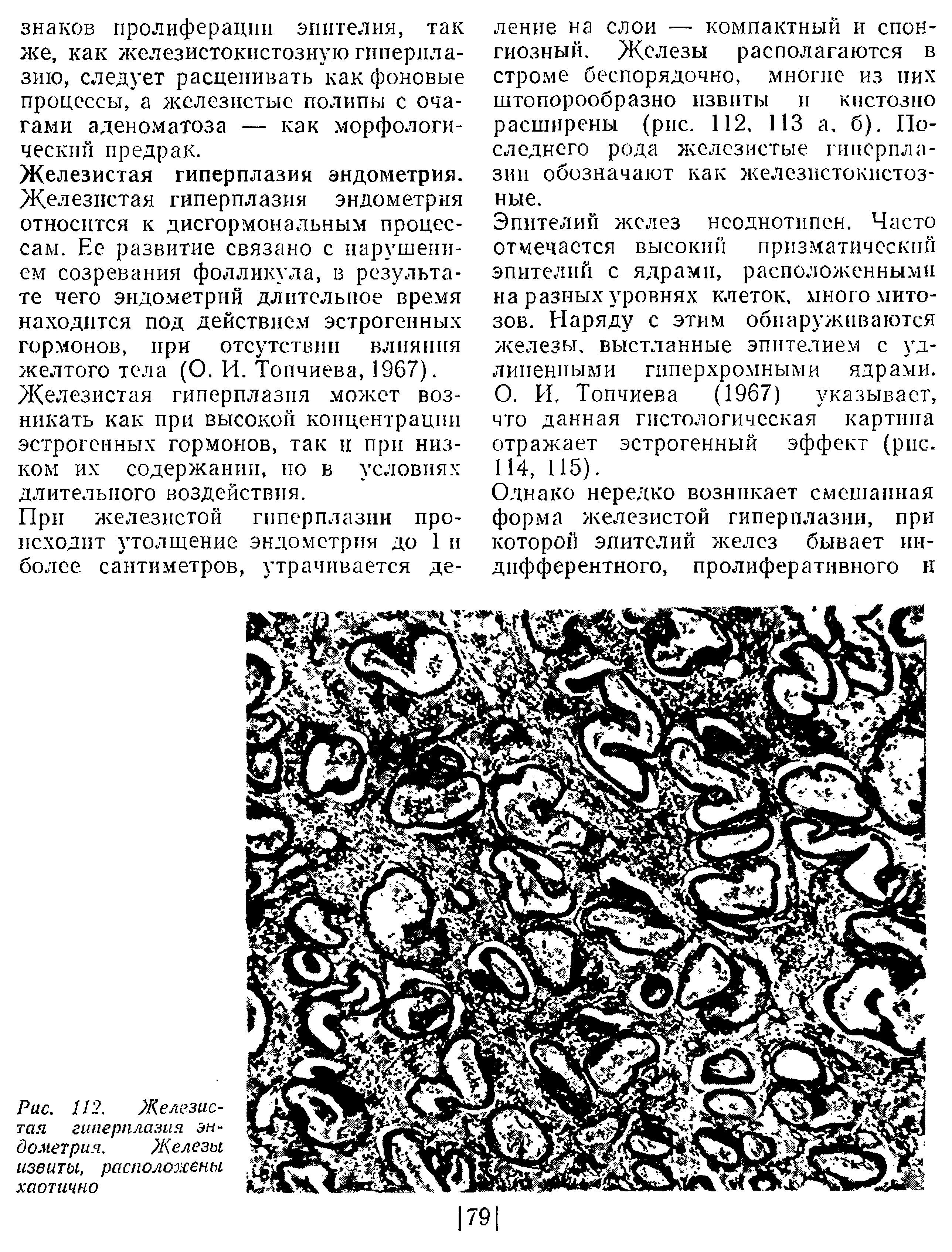 Рис. 112. Железистая гиперплазия эндометрия. Железы извиты, расположены хаотично...