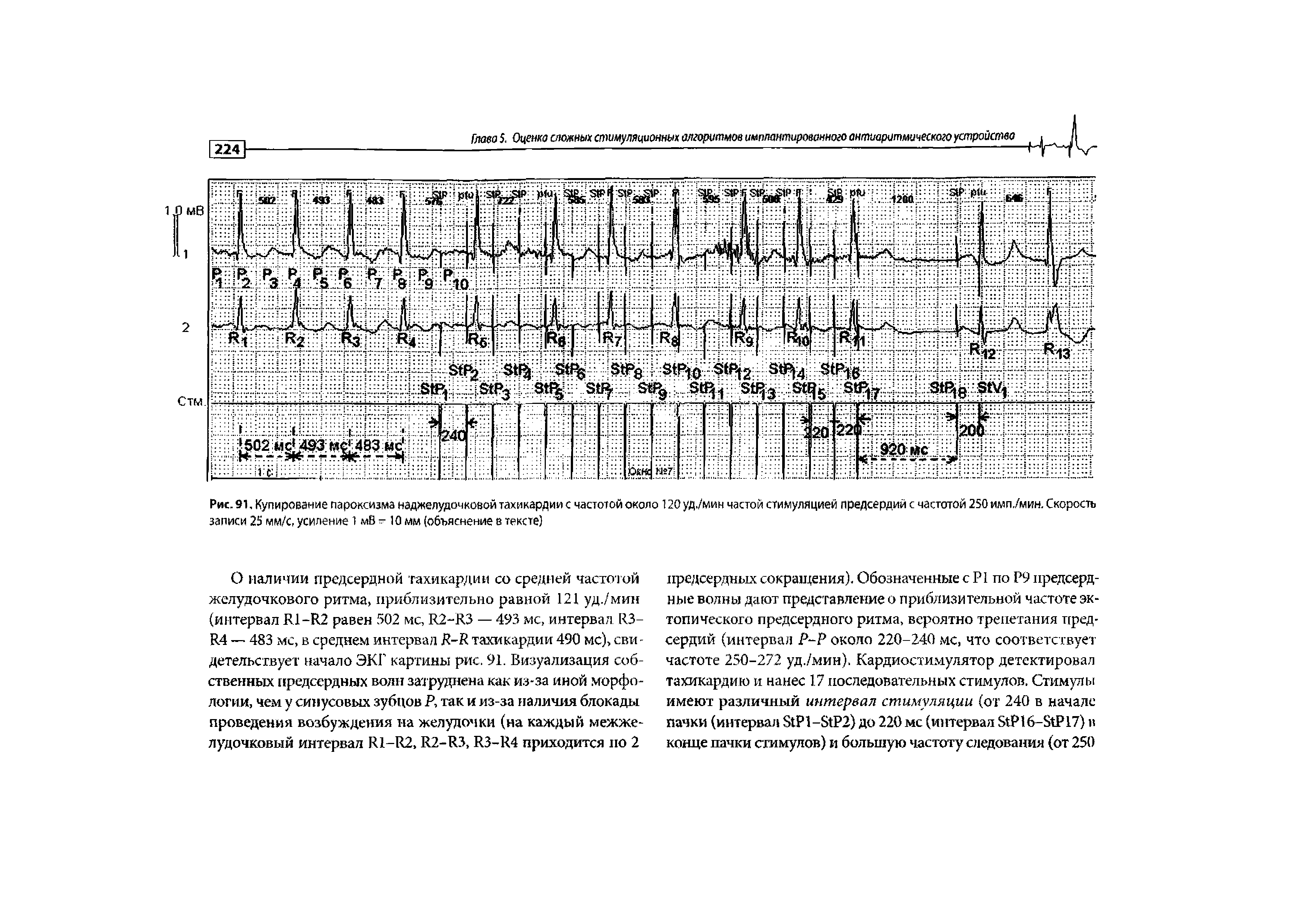 Рис. 91, Купирование пароксизма наджелудочковой тахикардии с частотой около 120 уд./мин частой стимуляцией предсердий с частотой 250 имп./мин. Скорость записи 25 мм/с, усиление 1 мВ - 10 мм (объяснение в тексте)...