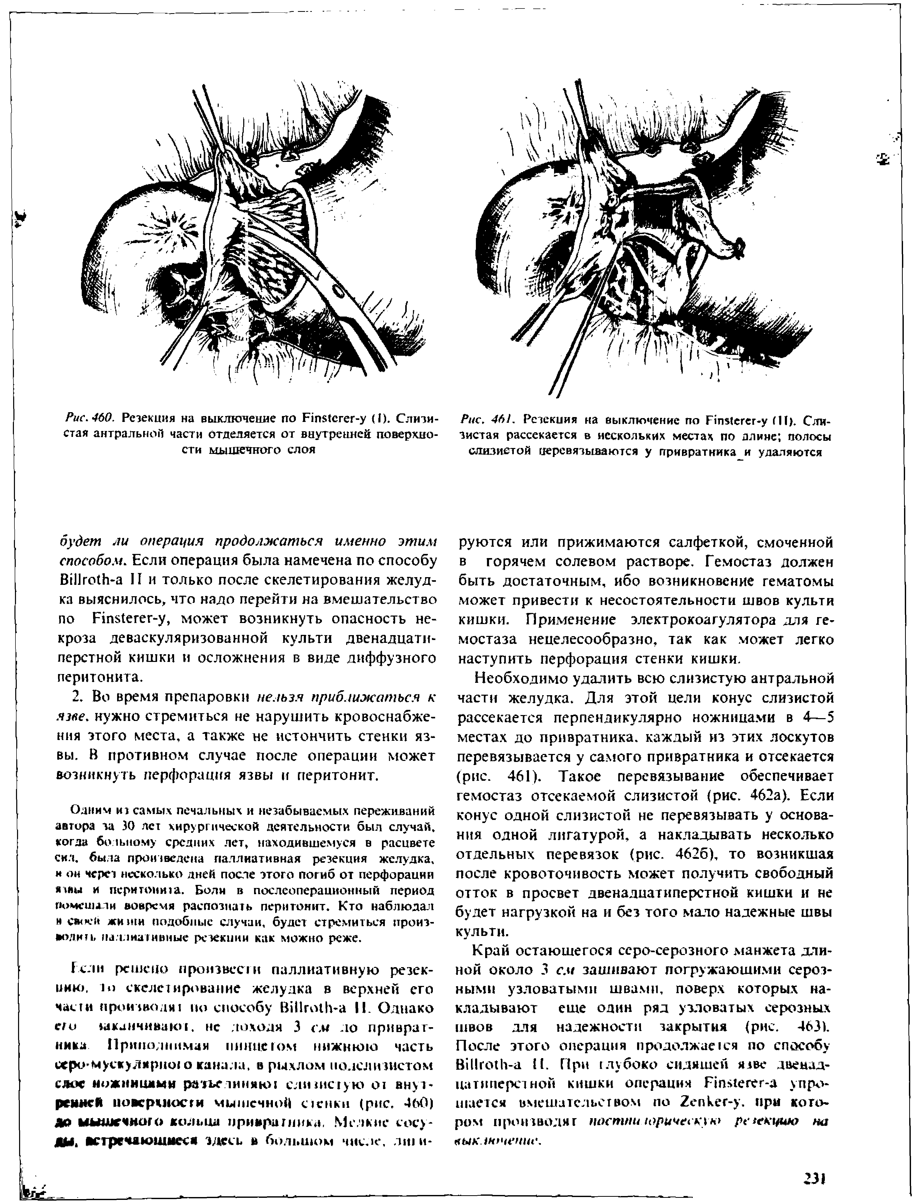 Рис. 461. Резекция на выключение по Р1п (егег-у (II). Слизистая рассекается в нескольких местах по длине полосы слизистой перевязываются у привратника и удаляются...