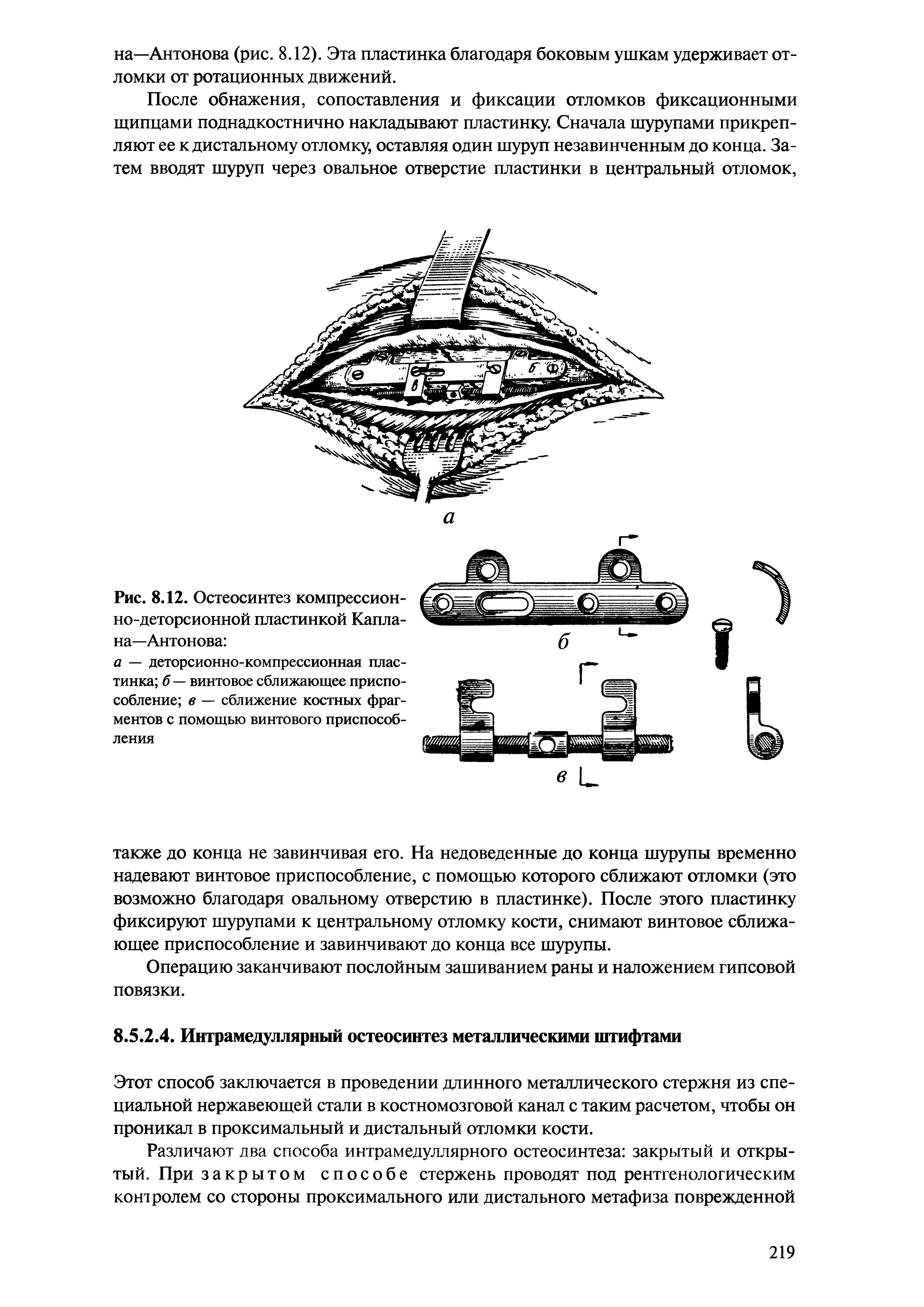 Рис. 8.12. Остеосинтез компрессион-но-деторсионной пластинкой Каплана-Антонова ...