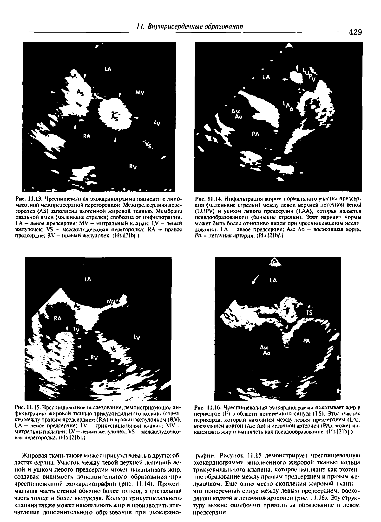 Рис. 11.13. Чреспищеводная эхокардиограмма пациента с лмло-магозной межпредсердной перегородкой.. Межпредсердная перегородка (А ) заполнена эхигенной жироной тканью. Мембрана овальной ямкн (маленькие стрелки) свободна от инфильтрации. 1А — ленпе предсердие МУ — митральный клапан IV - левый желудочек УЗ - межжелудочковая перегородка КА — правое предсердие ЙУ- пряный желудочек. (Ид (31Ь].)...