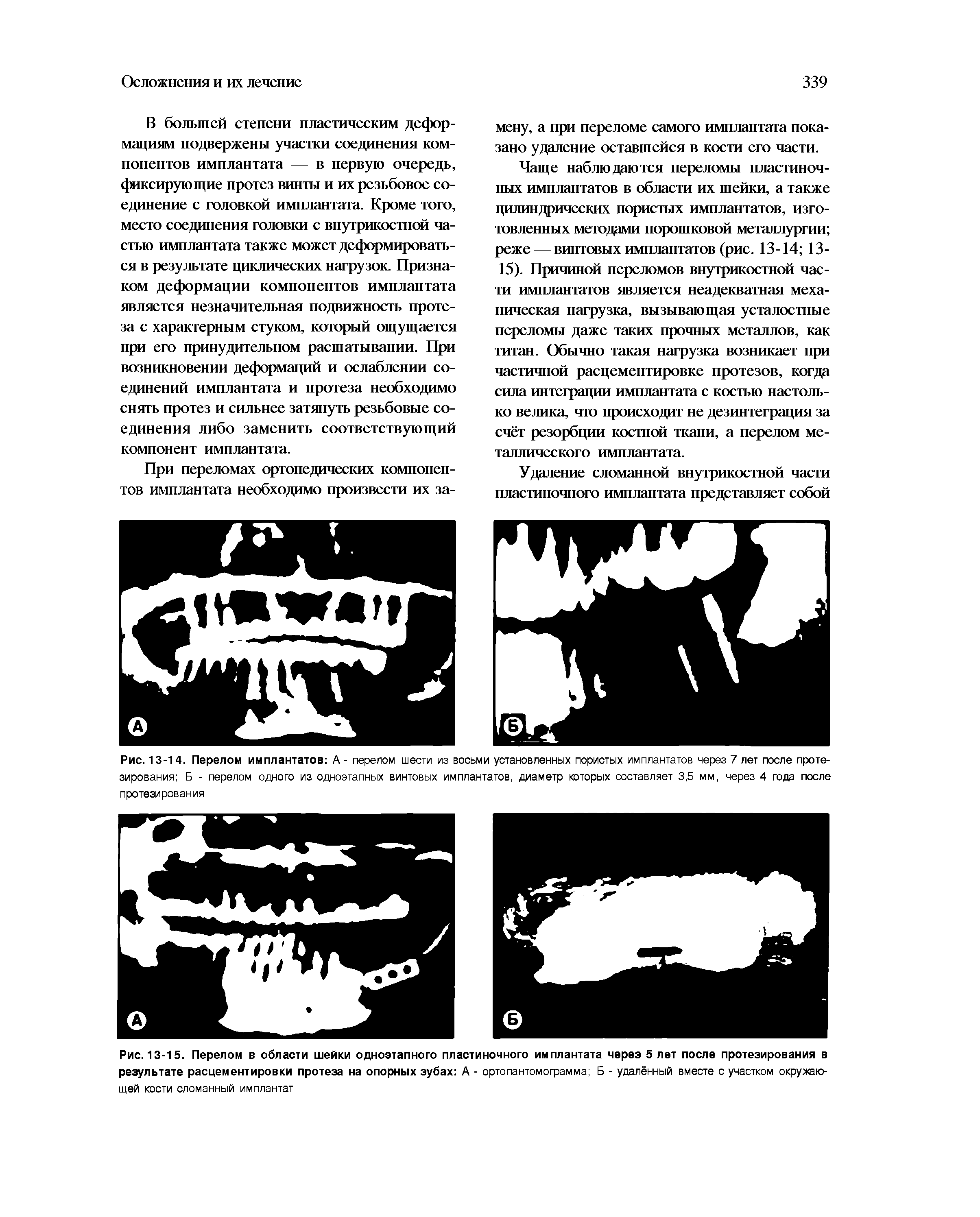 Рис. 13-14. Перелом имплантатов А - перелом шести из восьми установленных пористых имплантатов через 7 лет после протезирования Б - перелом одного из одноэтапных винтовых имплантатов, диаметр которых составляет 3,5 мм, через 4 года после протезирования...