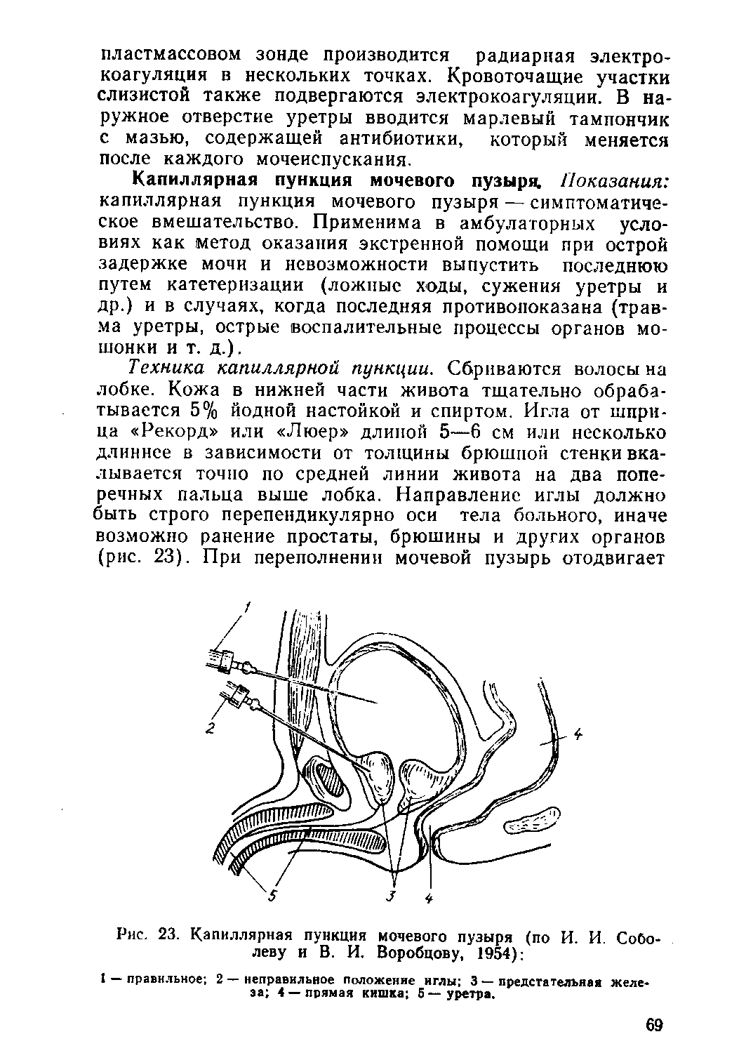 Рис. 23. Капиллярная пункция мочевого пузыря (по И. И. Соболеву и В. И. Воробцову, 1954) ...