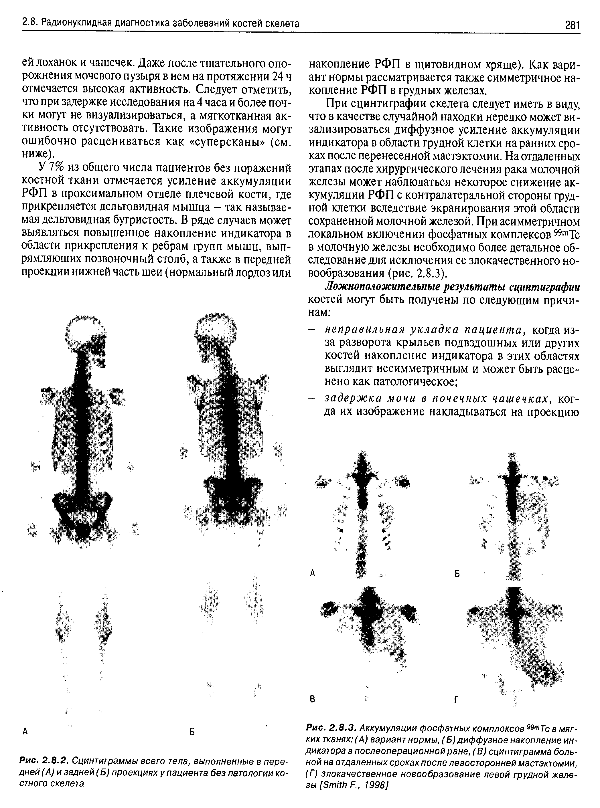 Рис. 2.8.3. Аккумуляции фосфатных комплексов 99тТс в мягких тканях (А) вариант нормы, (Б) диффузное накопление индикатора в послеоперационной ране, (В) сцинтиграмма больной на отдаленных сроках после левосторонней мастэктомии, (Г) злокачественное новообразование левой грудной железы [S F., 1998]...