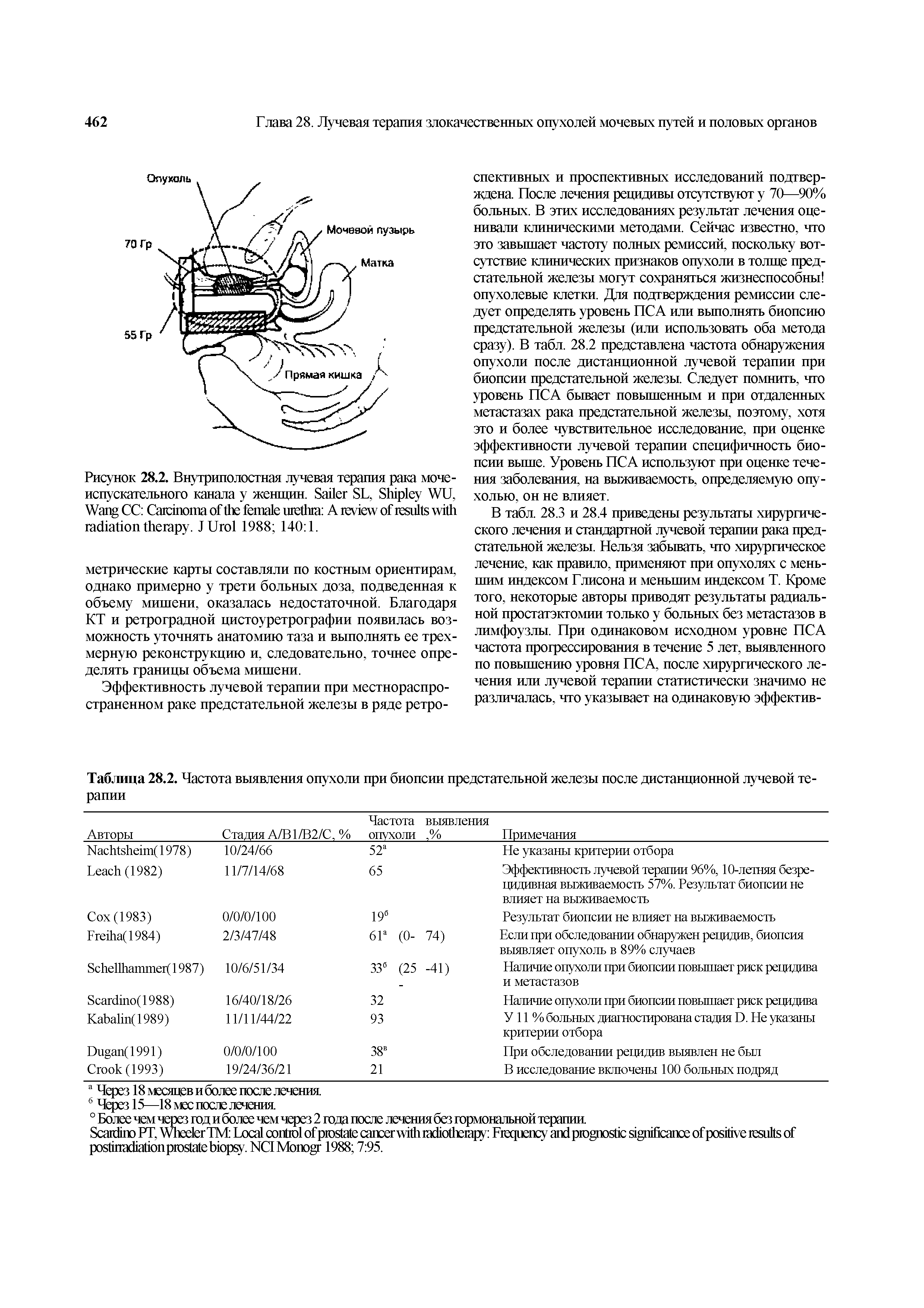 Рисунок 28.2. Внутриполостная лучевая терапия рака мочеиспускательного канала у женщин. S SL, S WU, W CC C A . J U 1988 140 1.