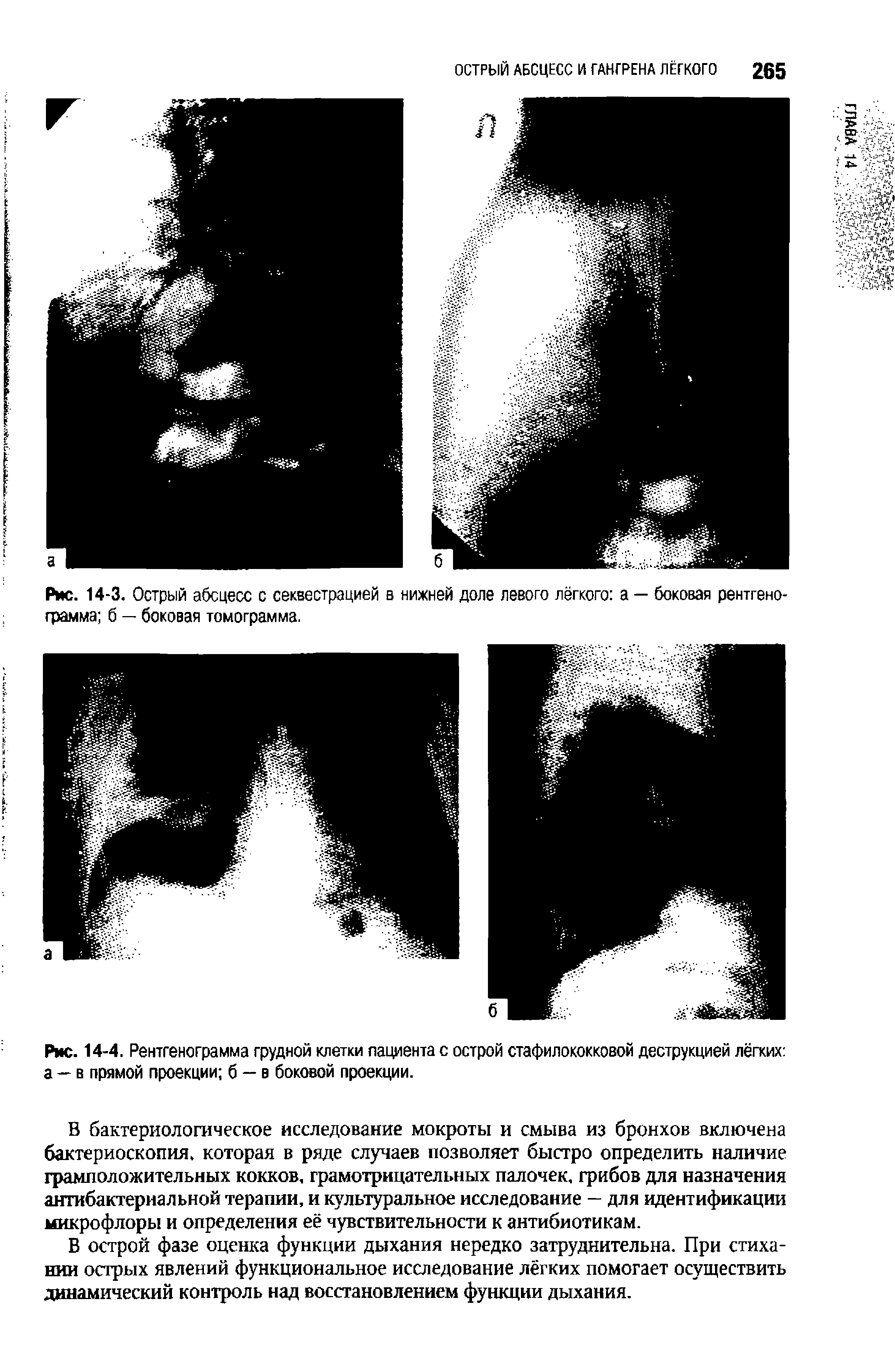Рис. 14-4. Рентгенограмма грудной клетки пациента с острой стафилококковой деструкцией лёгких а — в прямой проекции б — в боковой проекции.