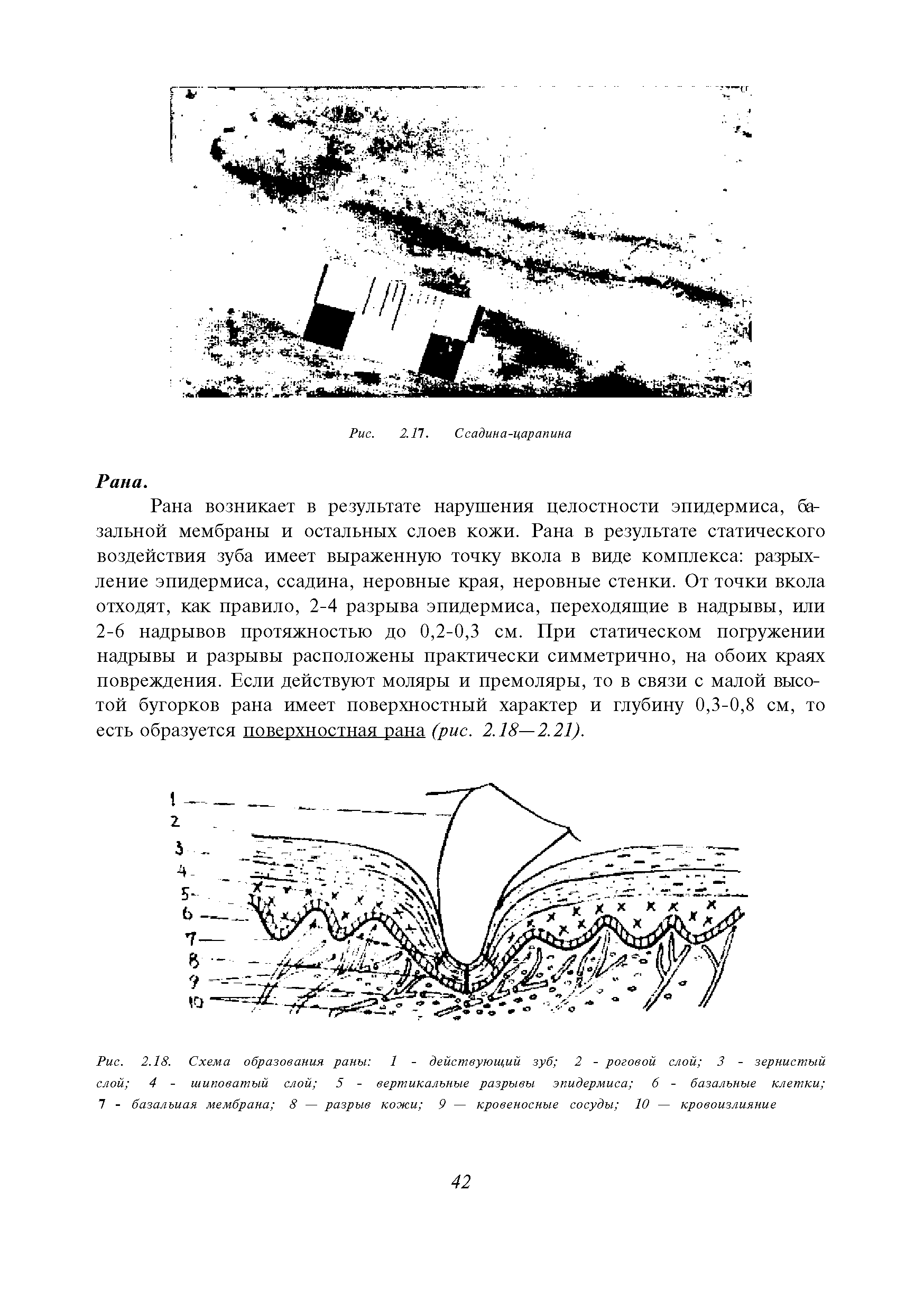 Рис. 2.18. Схема образования раны 1 - действующий зуб 2 - роговой слой 3 - зернистый слой 4 - шиповатый слой 5 - вертикальные разрывы эпидермиса 6 - базальные клетки 7 - базалъиая мембрана 8 — разрыв кожи 9 — кровеносные сосуды 10 — кровоизлияние...