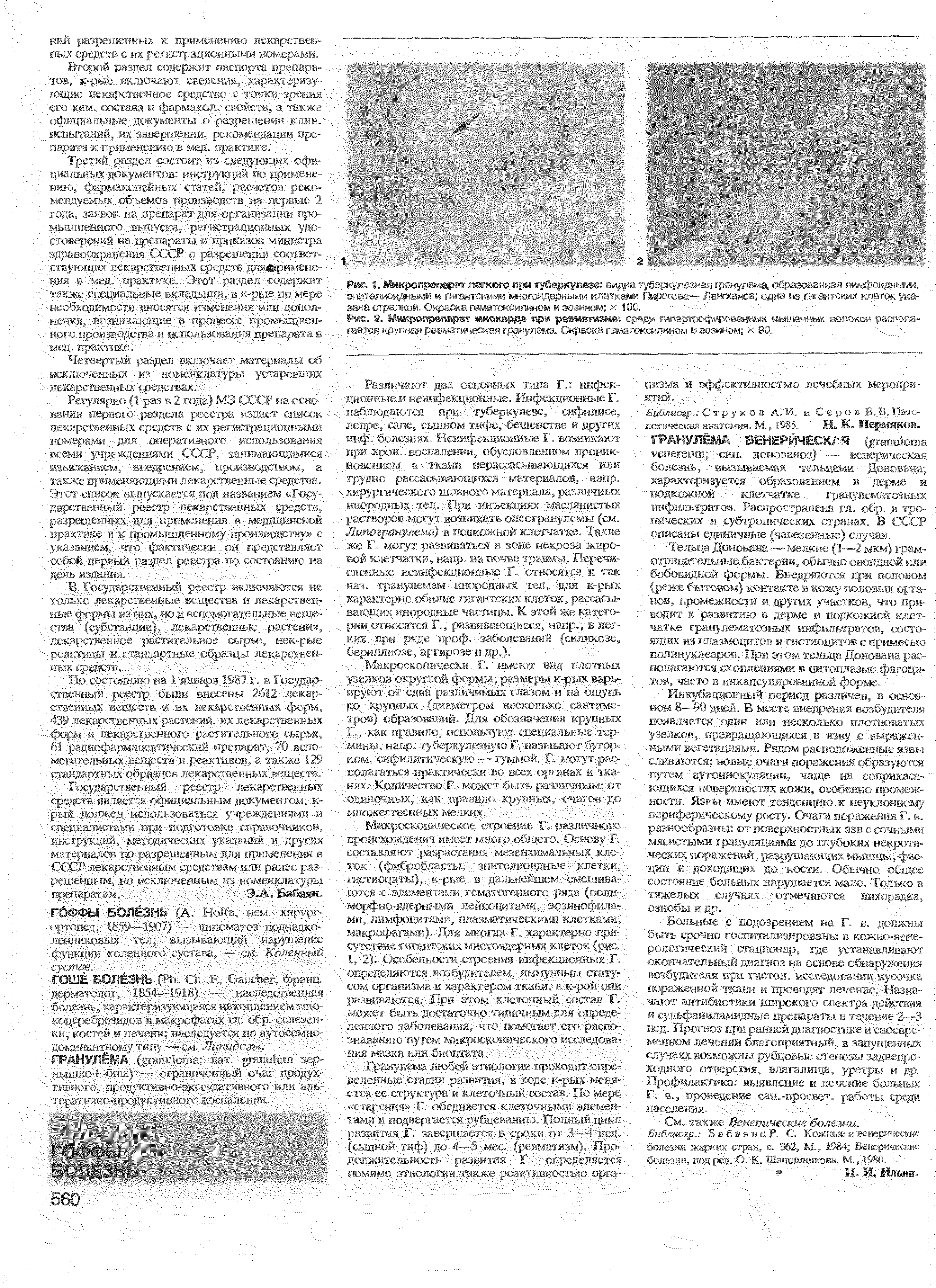 Рис. 2. Микропреперет миокарда при ревматизме среди гипертрофированных мышечных волокон располагается крупная ревматическая гранулема. Окра оксилином и эозином х 90. ...