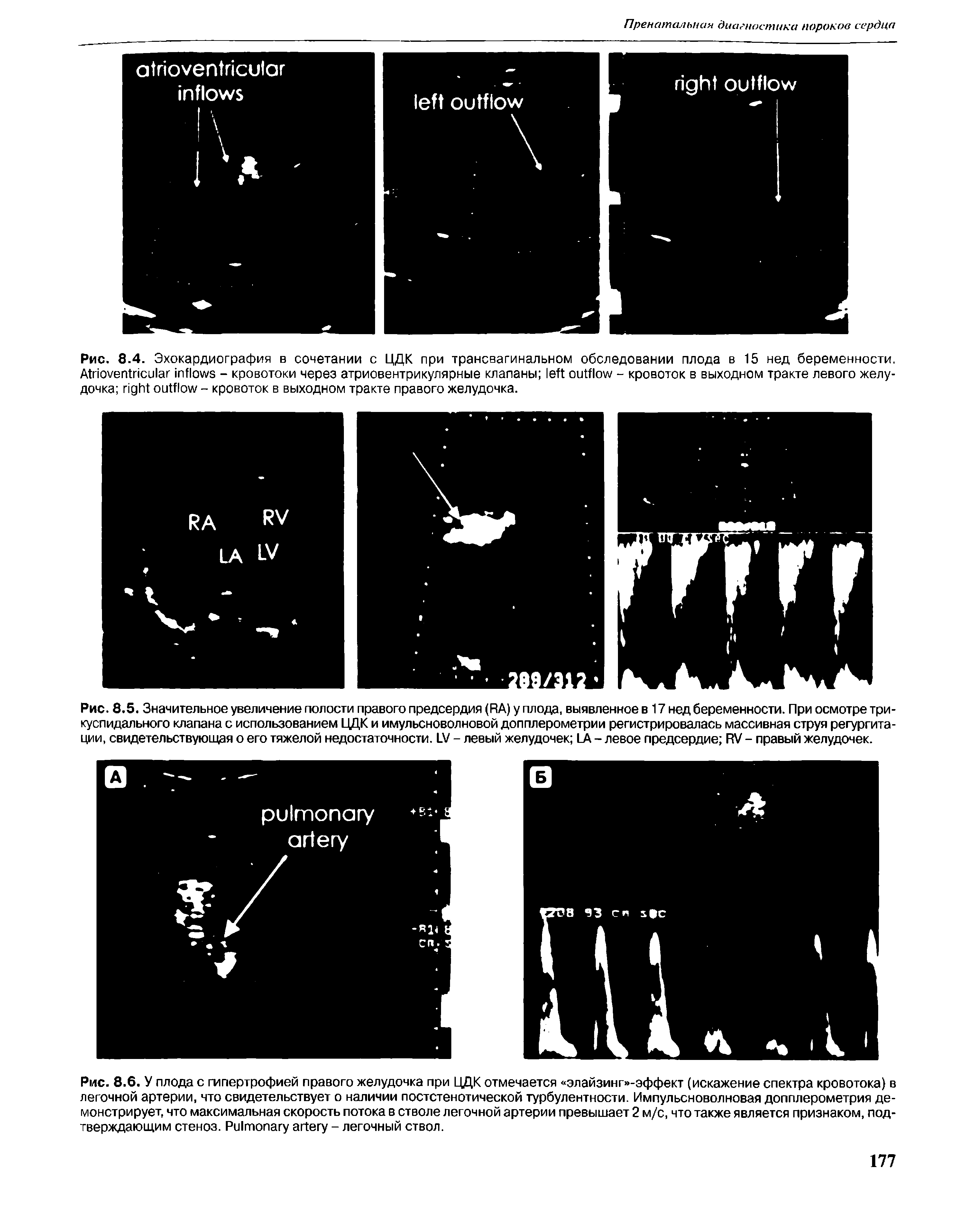 Рис. 8.4. Эхокардиография в сочетании с ЦДК при трансвагинальном обследовании плода в 15 нед беременности. A - кровотоки через атриовентрикулярные клапаны - кровоток в выходном тракте левого желудочка - кровоток в выходном тракте правого желудочка.