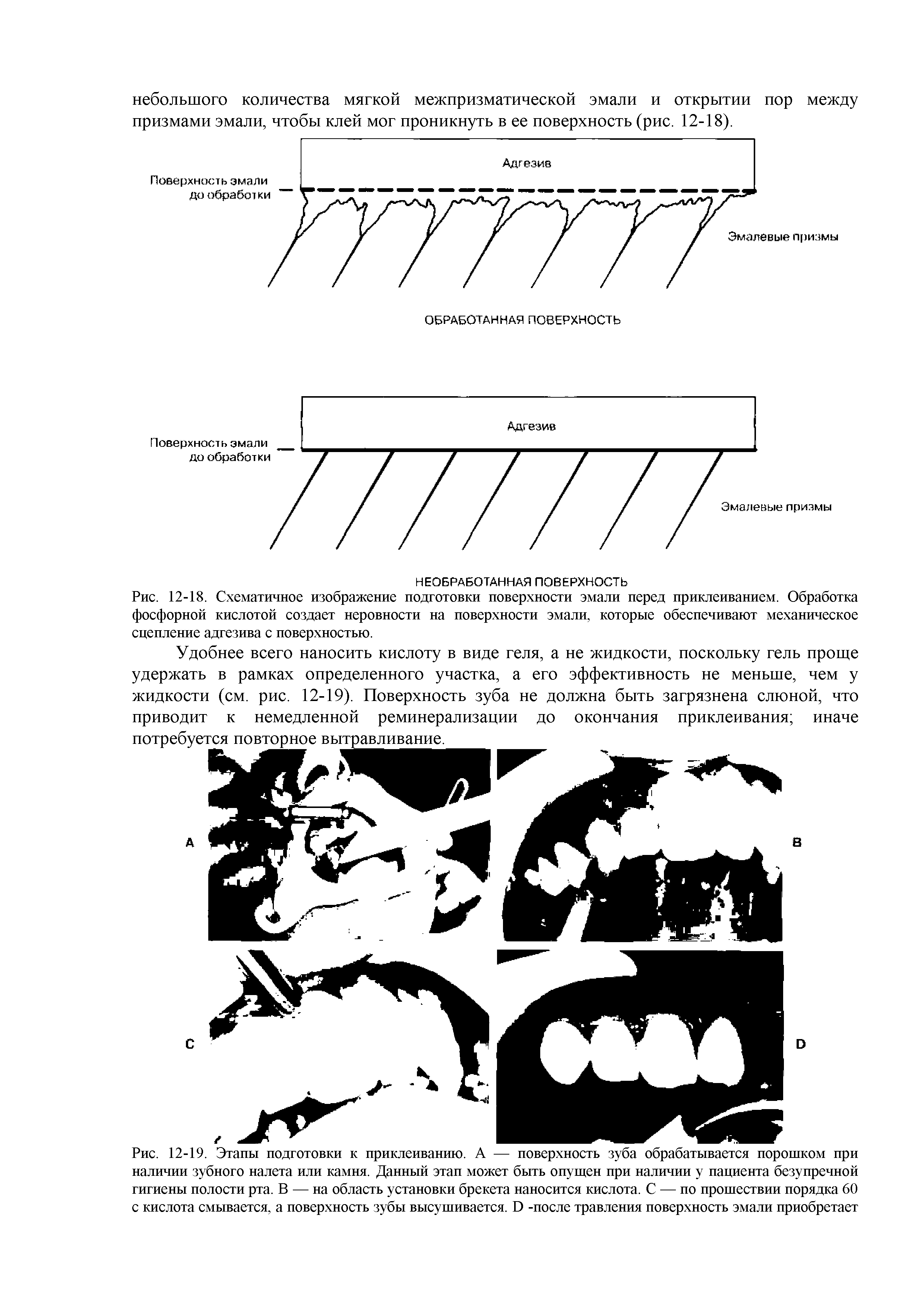 Рис. 12-18. Схематичное изображение подготовки поверхности эмали перед приклеиванием. Обработка фосфорной кислотой создает неровности на поверхности эмали, которые обеспечивают механическое сцепление адгезива с поверхностью.