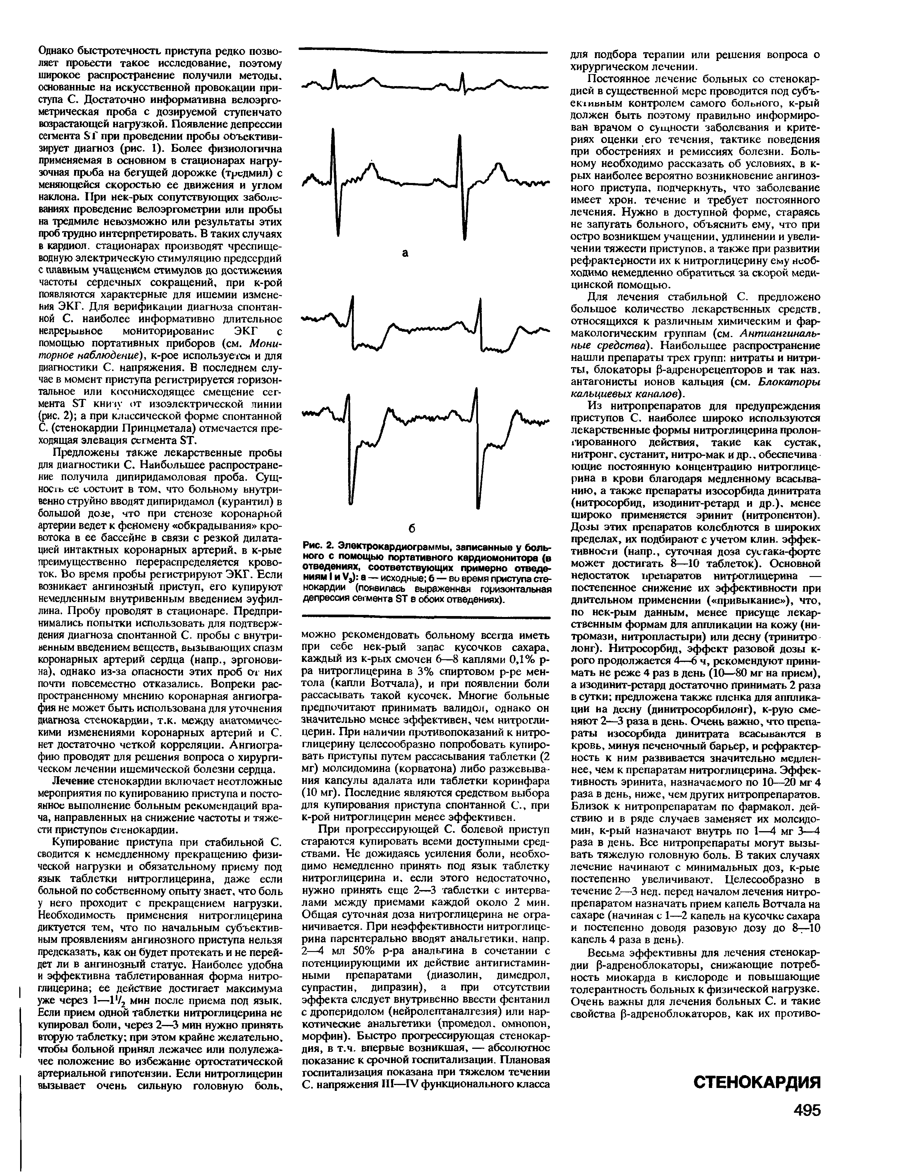 Рис. 2. Электрокардиограммы, записанные у больного с помощью портативного кардиомонитора (в отведениях, соответствующих примерно отведениям I и Уз) а — исходные б — во время приступа стенокардии (появилась выраженная горизонтальная депрессия сегмента ЭТ в обоих отведениях).