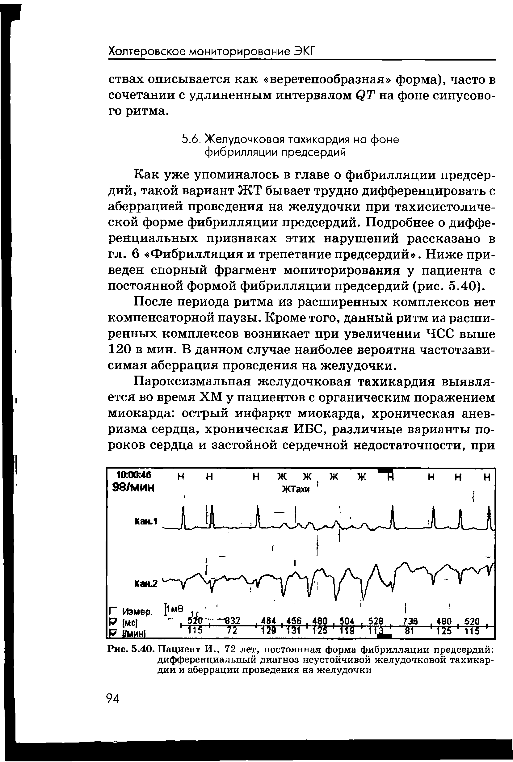 Рис. 5.40. Пациент И., 72 лет, постоянная форма фибрилляции предсердий дифференциальный диагноз неустойчивой желудочковой тахикардии и аберрации проведения на желудочки...