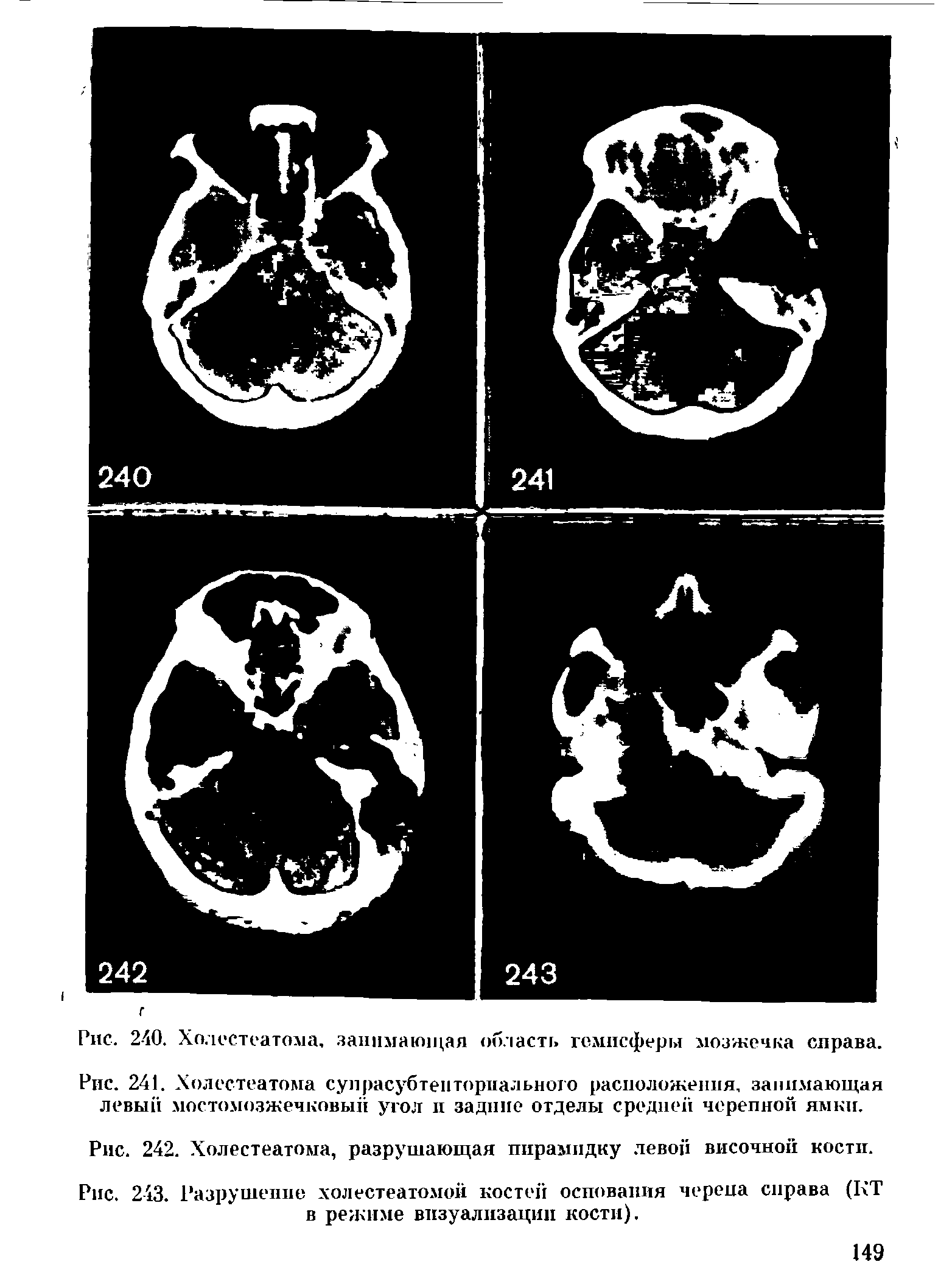 Рис. 241. Холестеатома супрасубтенториального расположения, занимающая левый мостомозжечковый угол и задние отделы средней черепной ямки.