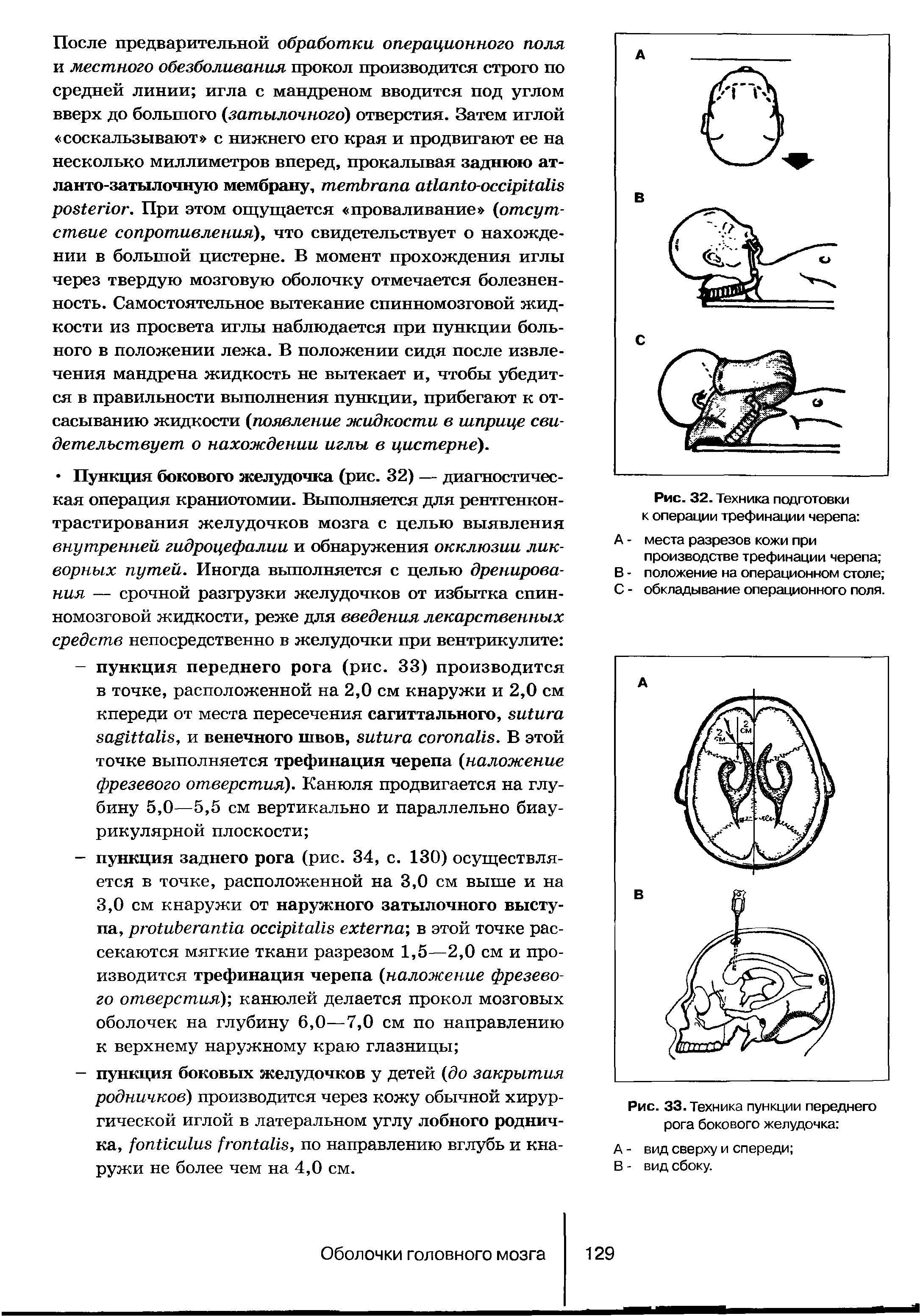 Рис. 33. Техника пункции переднего рога бокового желудочка ...