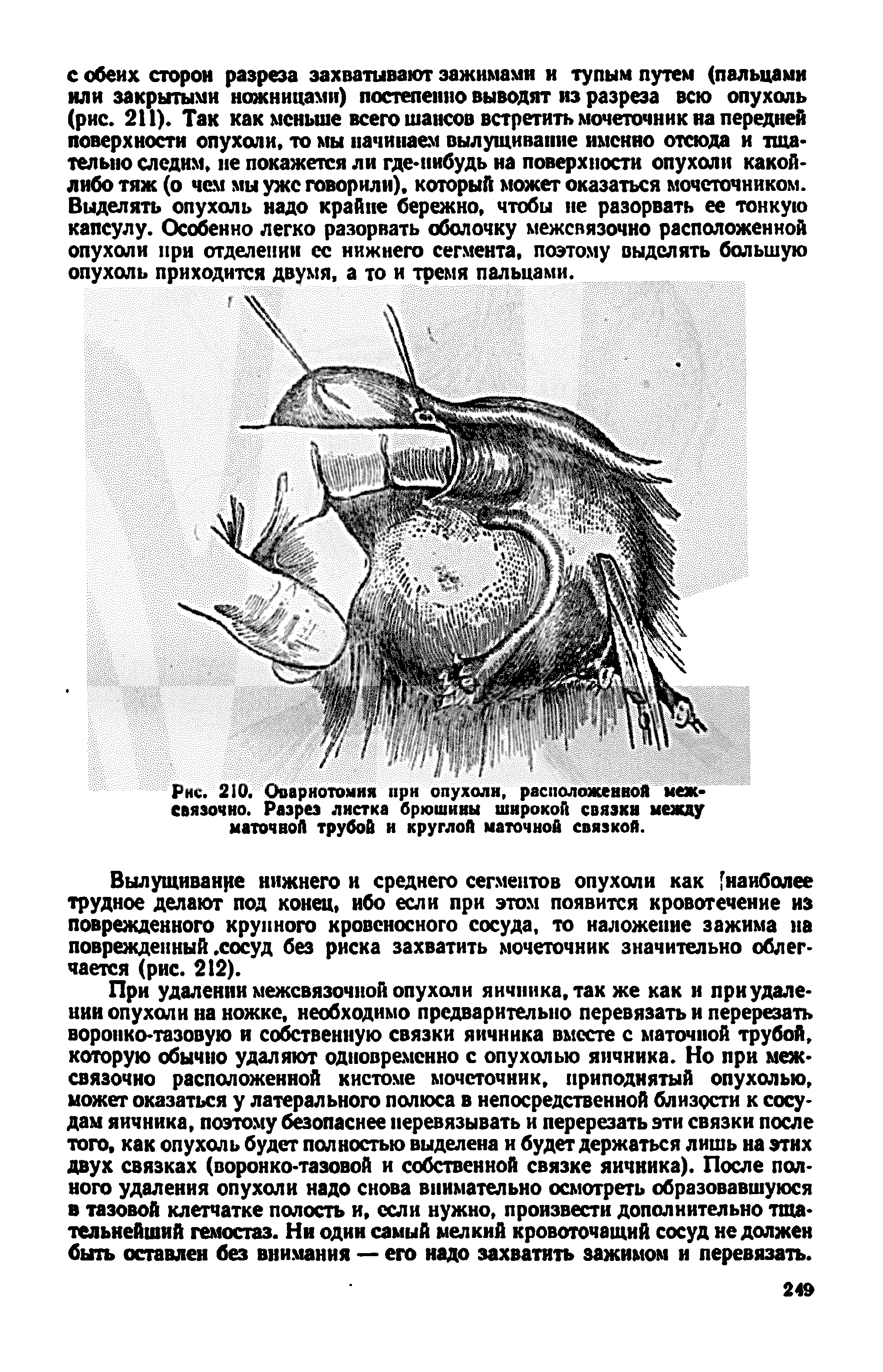 Рис. 210. Овариотомия при опухоли, расположенной межсвязочно. Разрез листка брюшины широкой связки между маточной трубой и круглой маточной связкой.