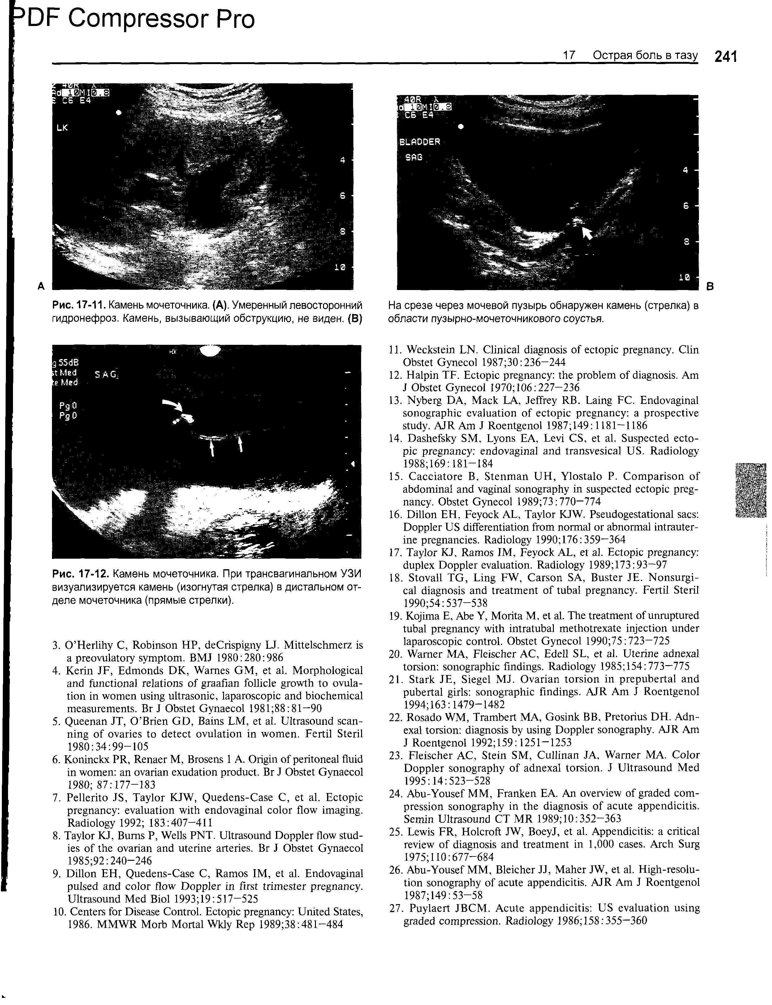 Рис. 17-12. Камень мочеточника. При трансвагинальном УЗИ визуализируется камень (изогнутая стрелка) в дистальном отделе мочеточника (прямые стрелки).