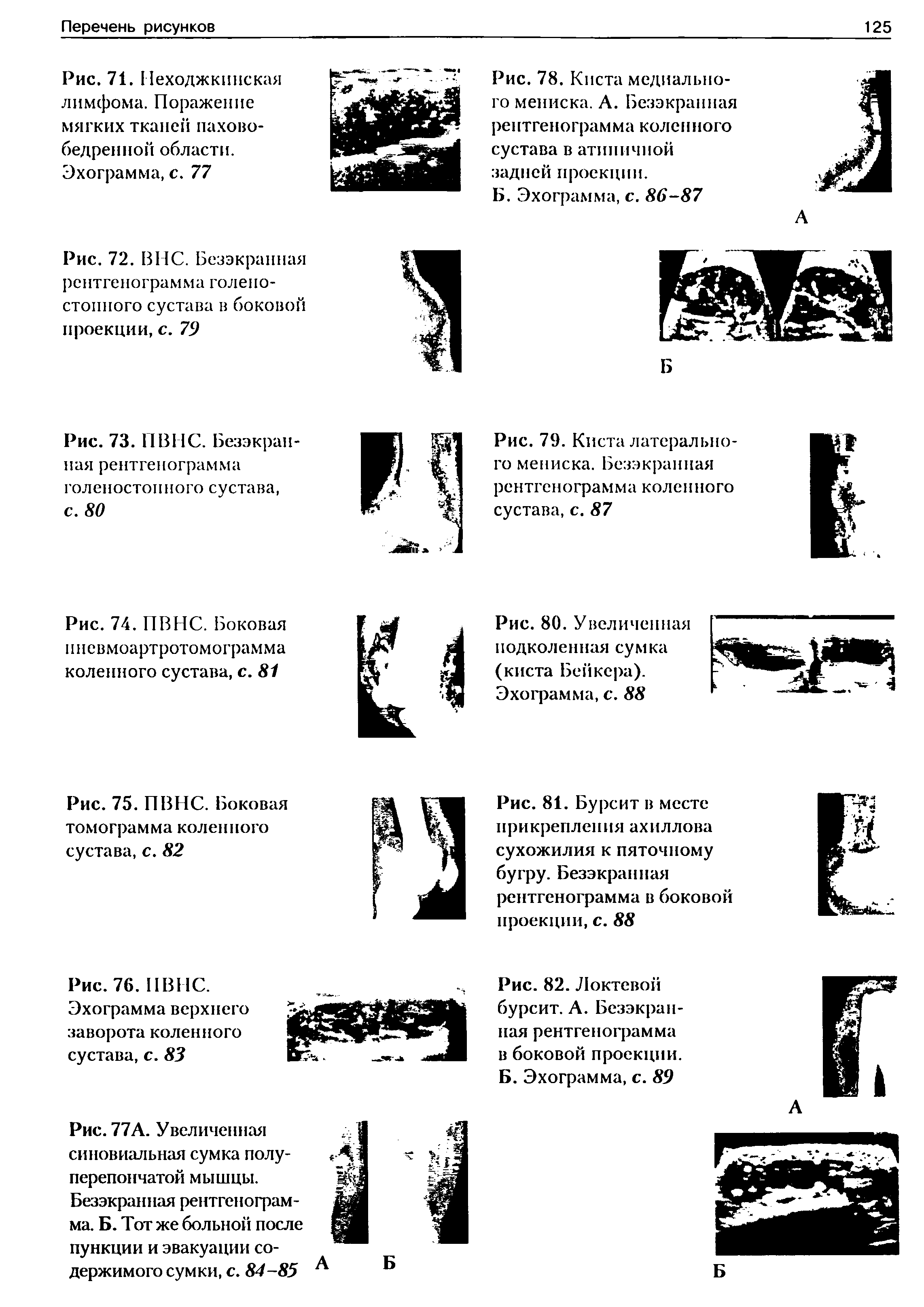 Рис. 82. Локтевой бурсит. А. Безэкранная рентгенограмма в боковой проекции. Б. Эхограмма, с. 89...
