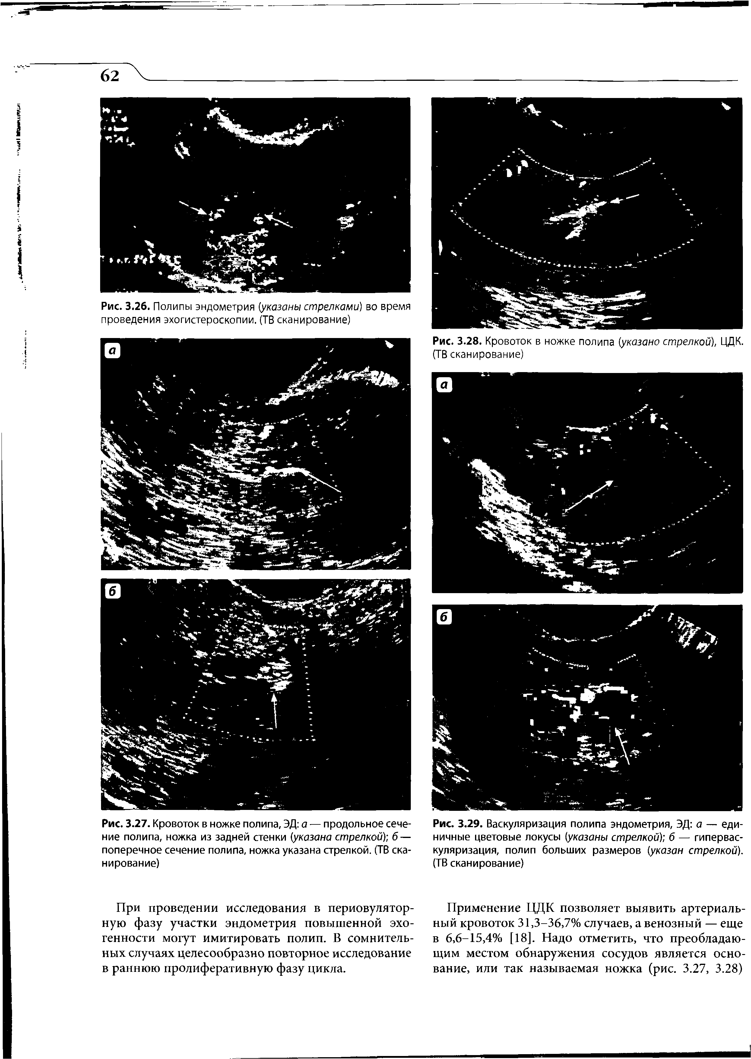 Рис. 3.29. Васкуляризация полипа эндометрия, ЭД а — единичные цветовые локусы (указаны стрелкой) б — гиперваскуляризация, полип больших размеров (указан стрелкой). (ТВ сканирование)...