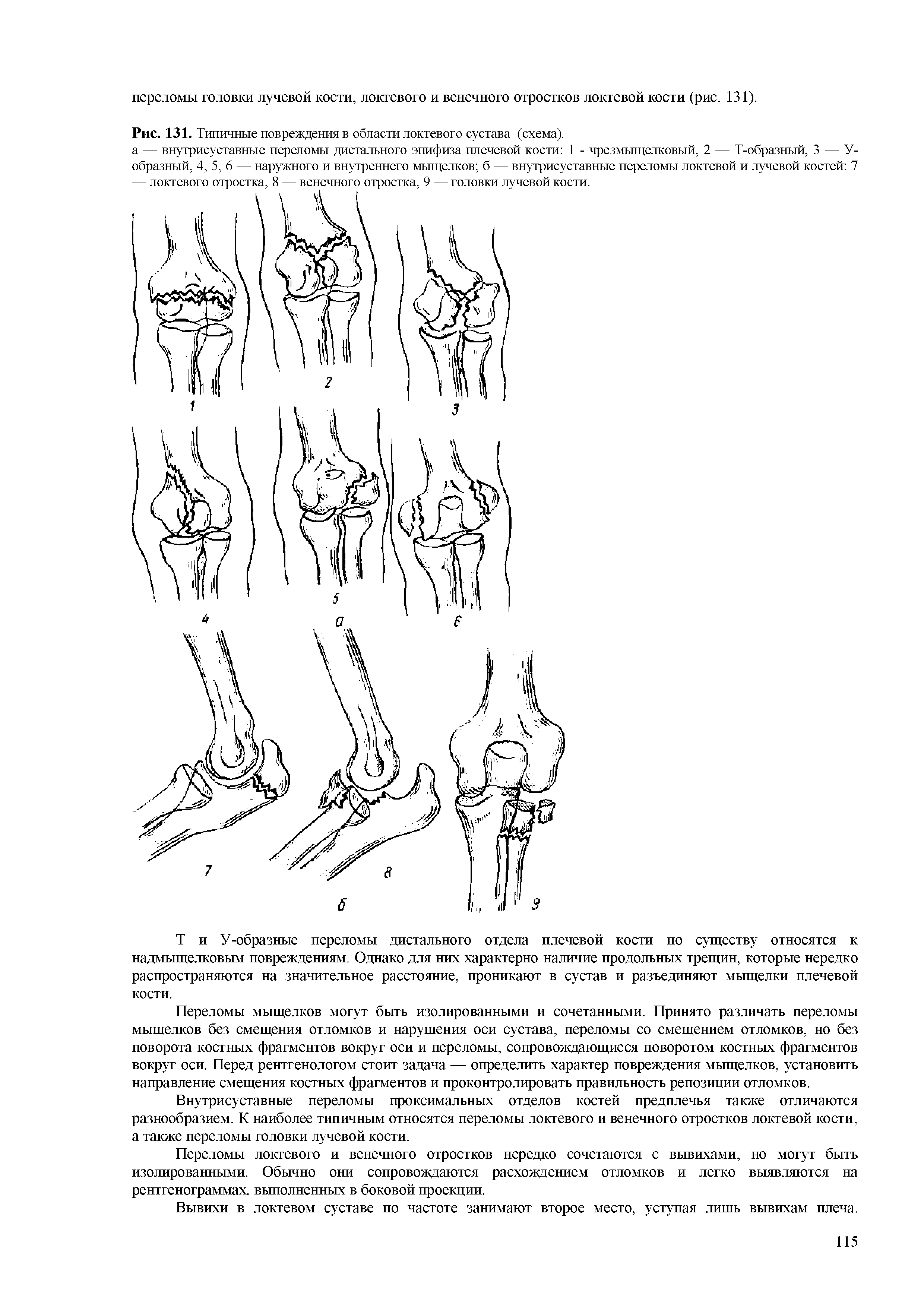 Рис. 131. Типичные повреждения в области локтевого сустава (схема).