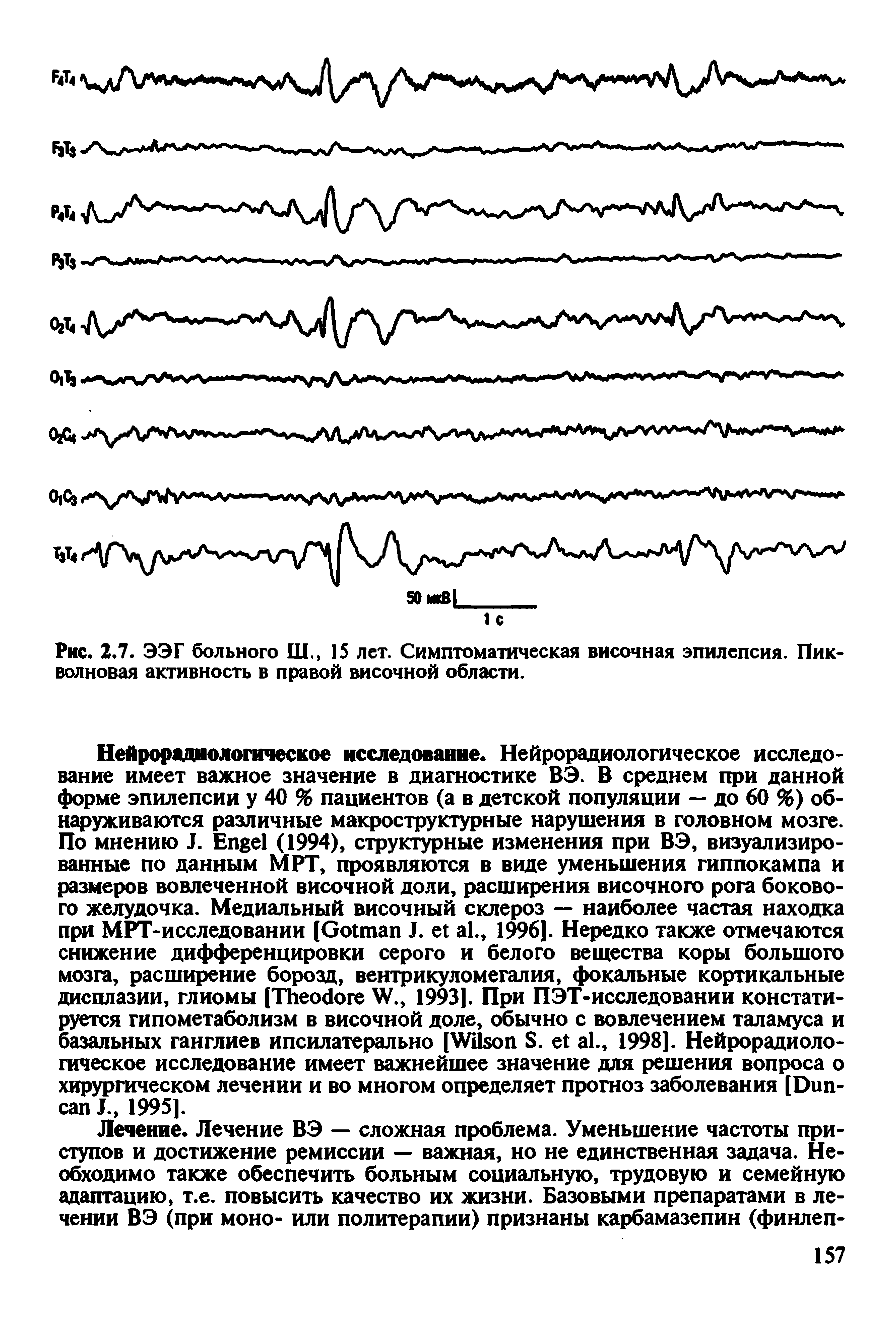 Рис. 2.7. ЭЭГ больного Ш., 15 лет. Симптоматическая височная эпилепсия. Пик волновая активность в правой височной области.