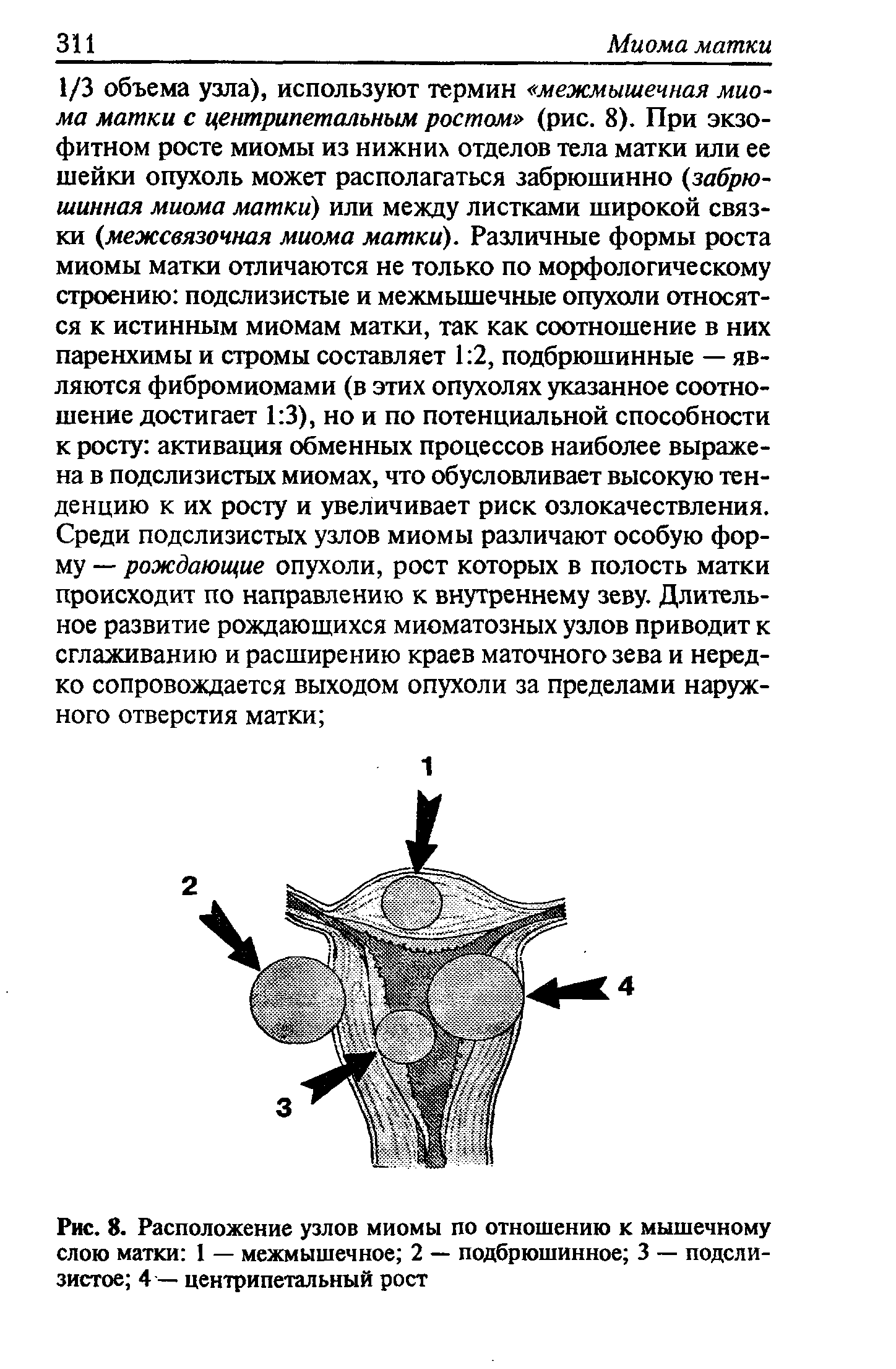 Рис. 8. Расположение узлов миомы по отношению к мышечному слою матки 1 — межмышечное 2 — подбрюшинное 3 — подслизистое 4 — центрипетальный рост...