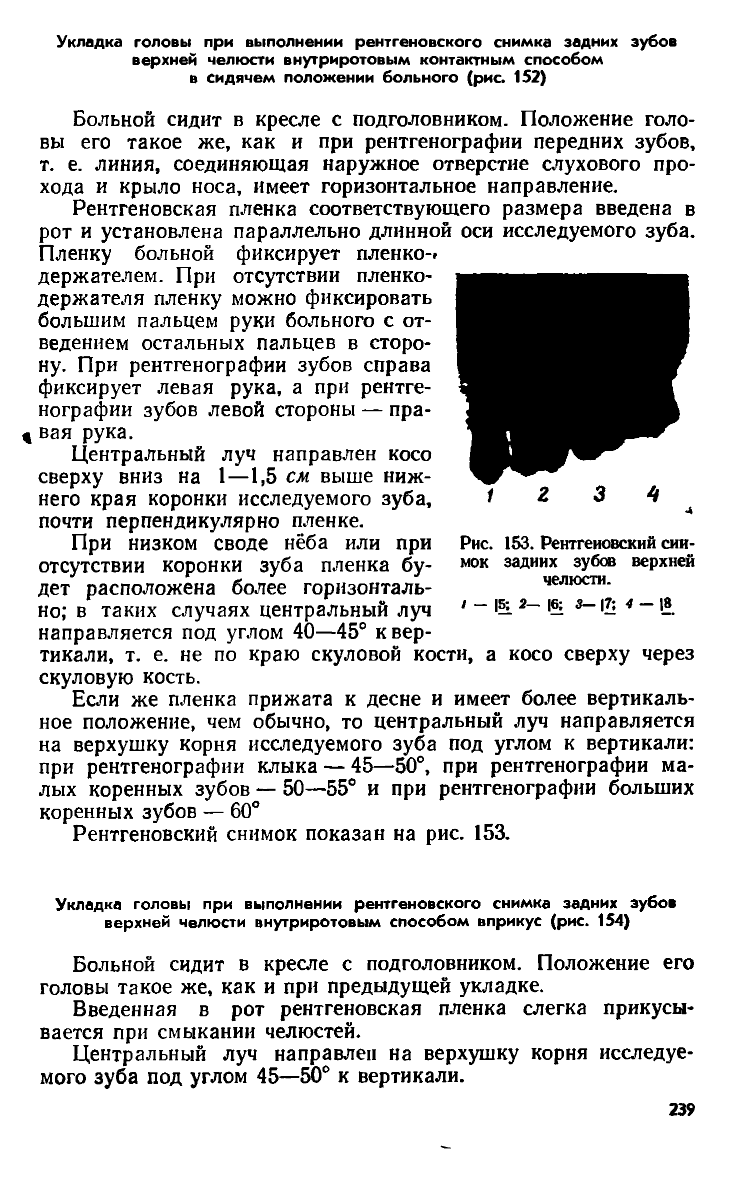 Рис. 153. Рентгеновский снимок задних зубов верхней челюсти.