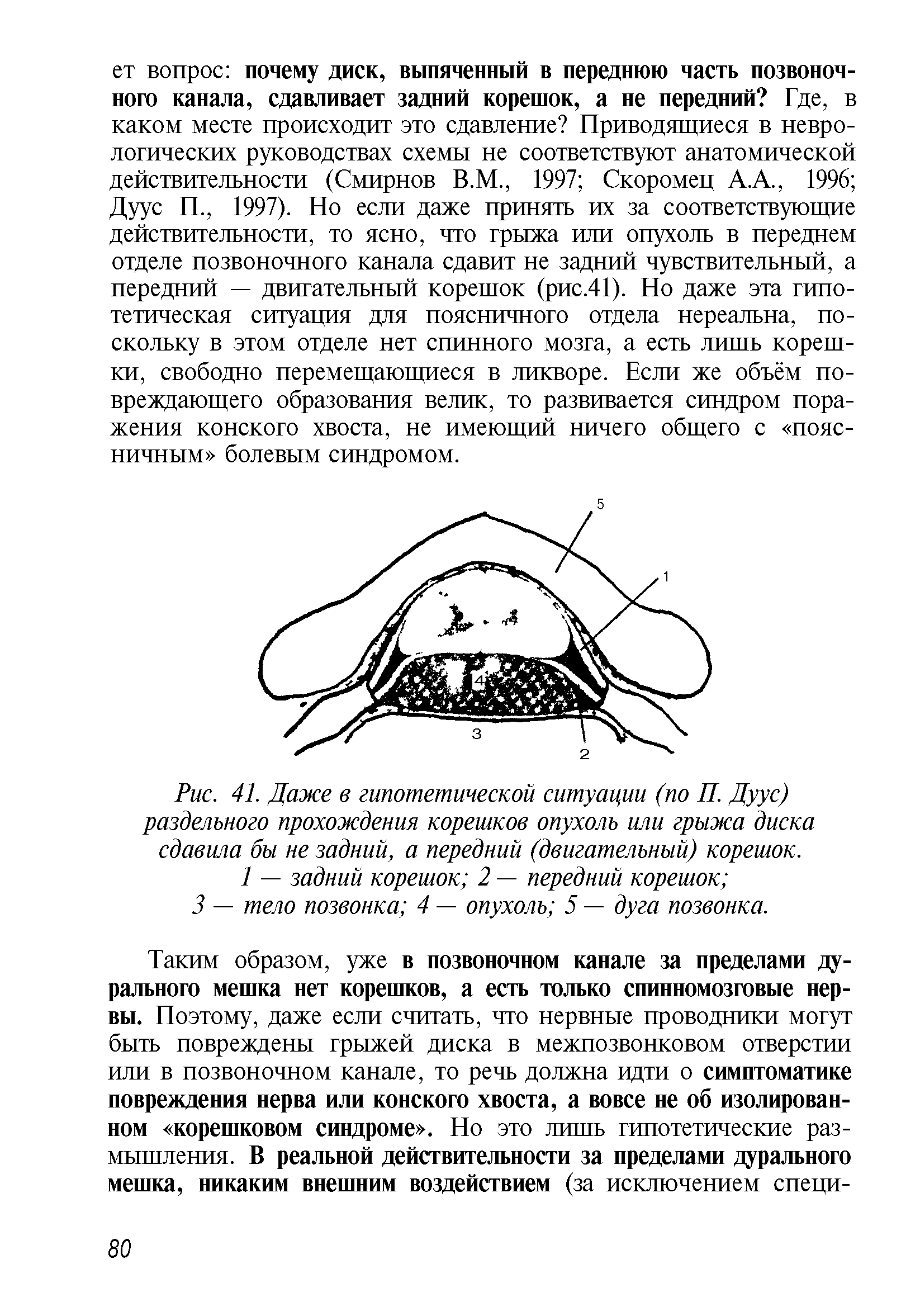 Рис. 41. Даже в гипотетической ситуации (по П. Дуус) раздельного прохождения корешков опухоль или грыжа диска сдавила бы не задний, а передний (двигательный) корешок.