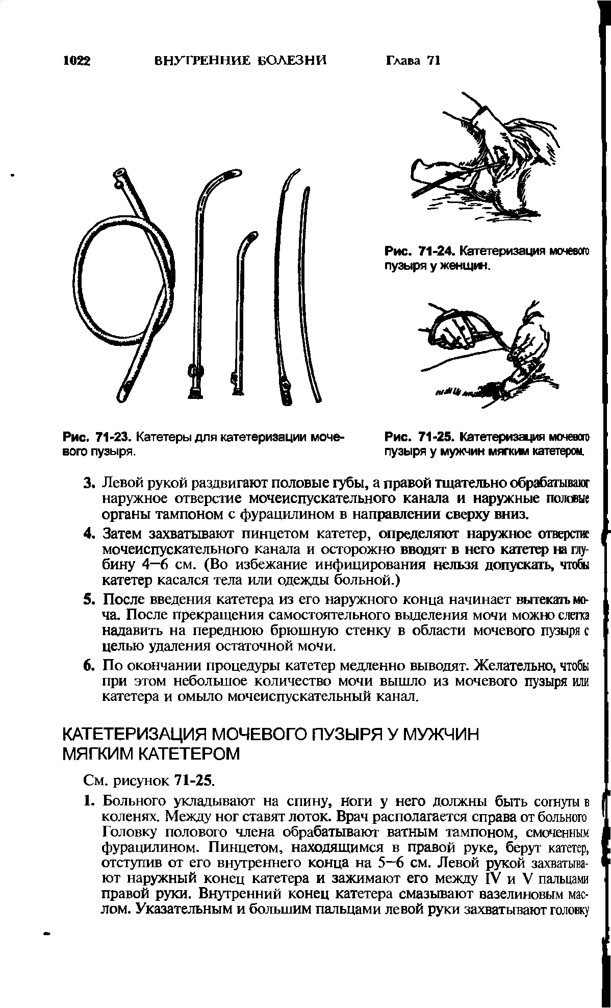 Рис. 71-25. Катетеризация мочевого пузыря у мужчин мягким катетером.