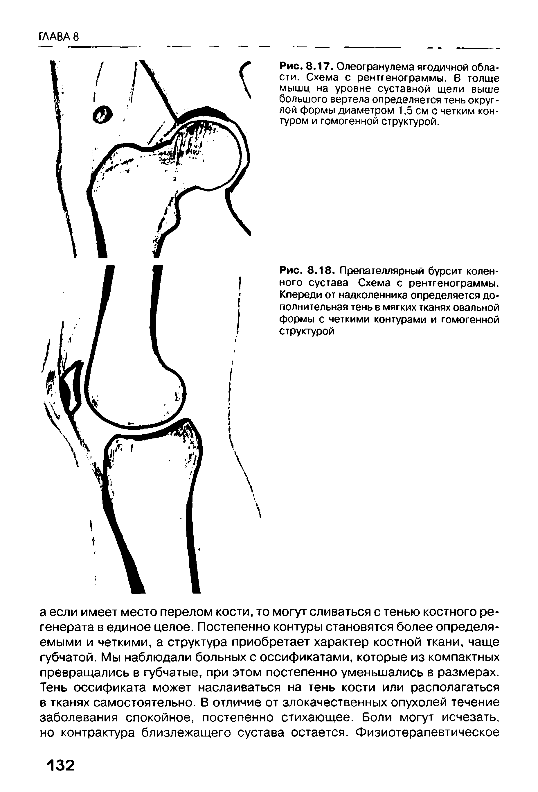 Рис. 8.18. Препателлярный бурсит коленного сустава Схема с рентгенограммы. Кпереди от надколенника определяется дополнительная тень в мягких тканях овальной формы с четкими контурами и гомогенной структурой...
