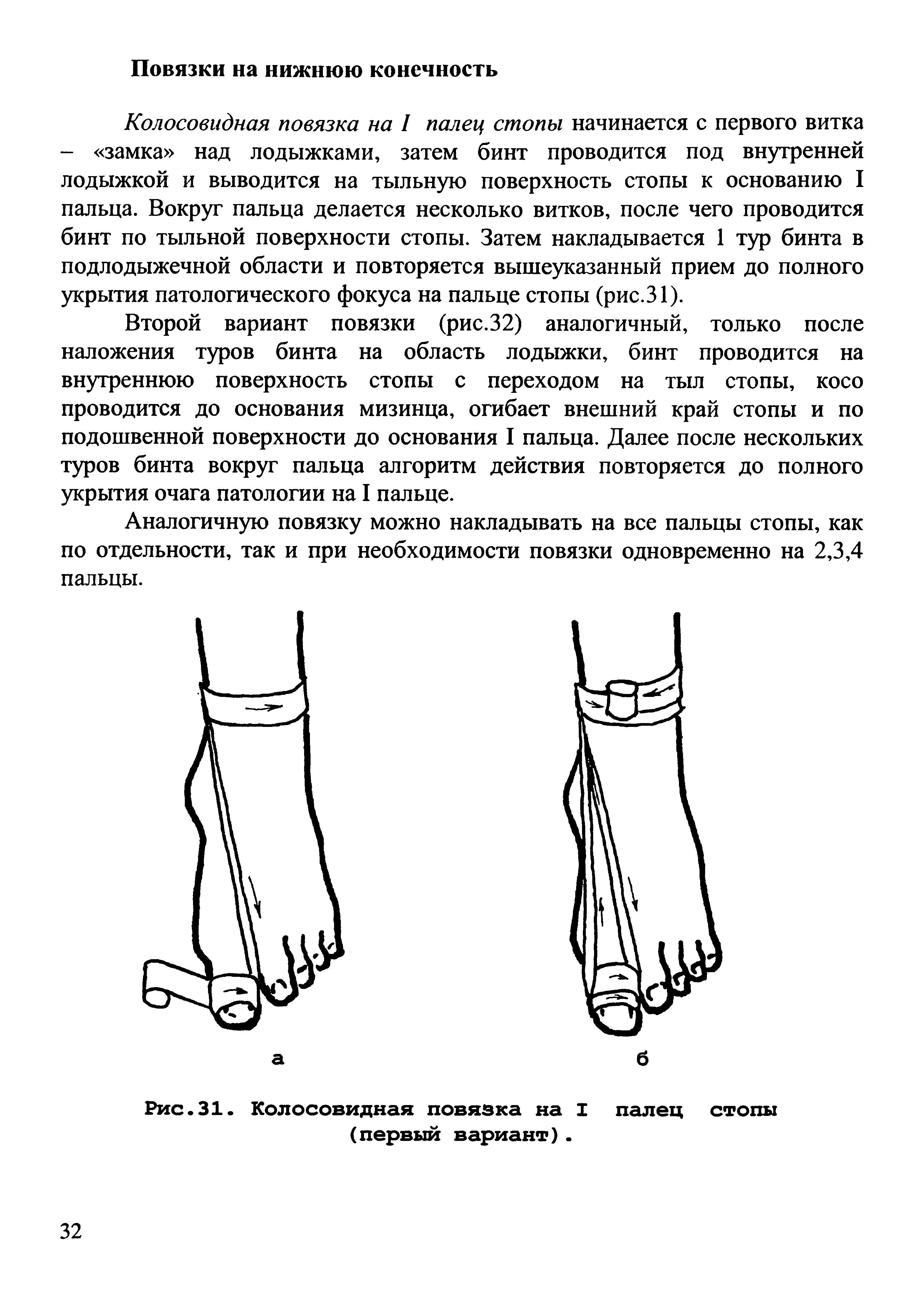 Рис.31. Колосовидная повязка на I палец стопы (первый вариант).