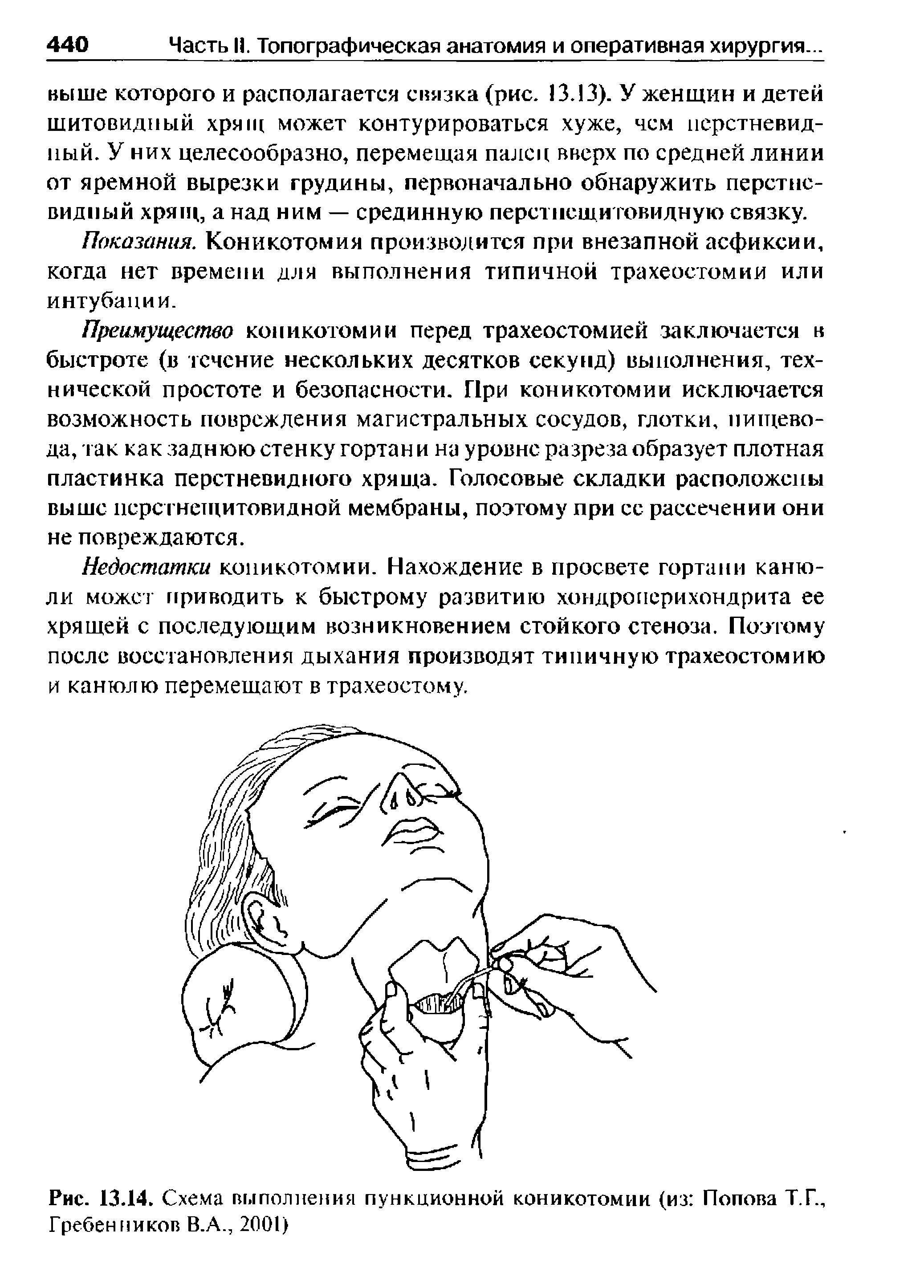 Рис. 13.14. Схема выполнения пункционной коникотомии (из Попова Т.Г., Гребенников В.А., 2001)...