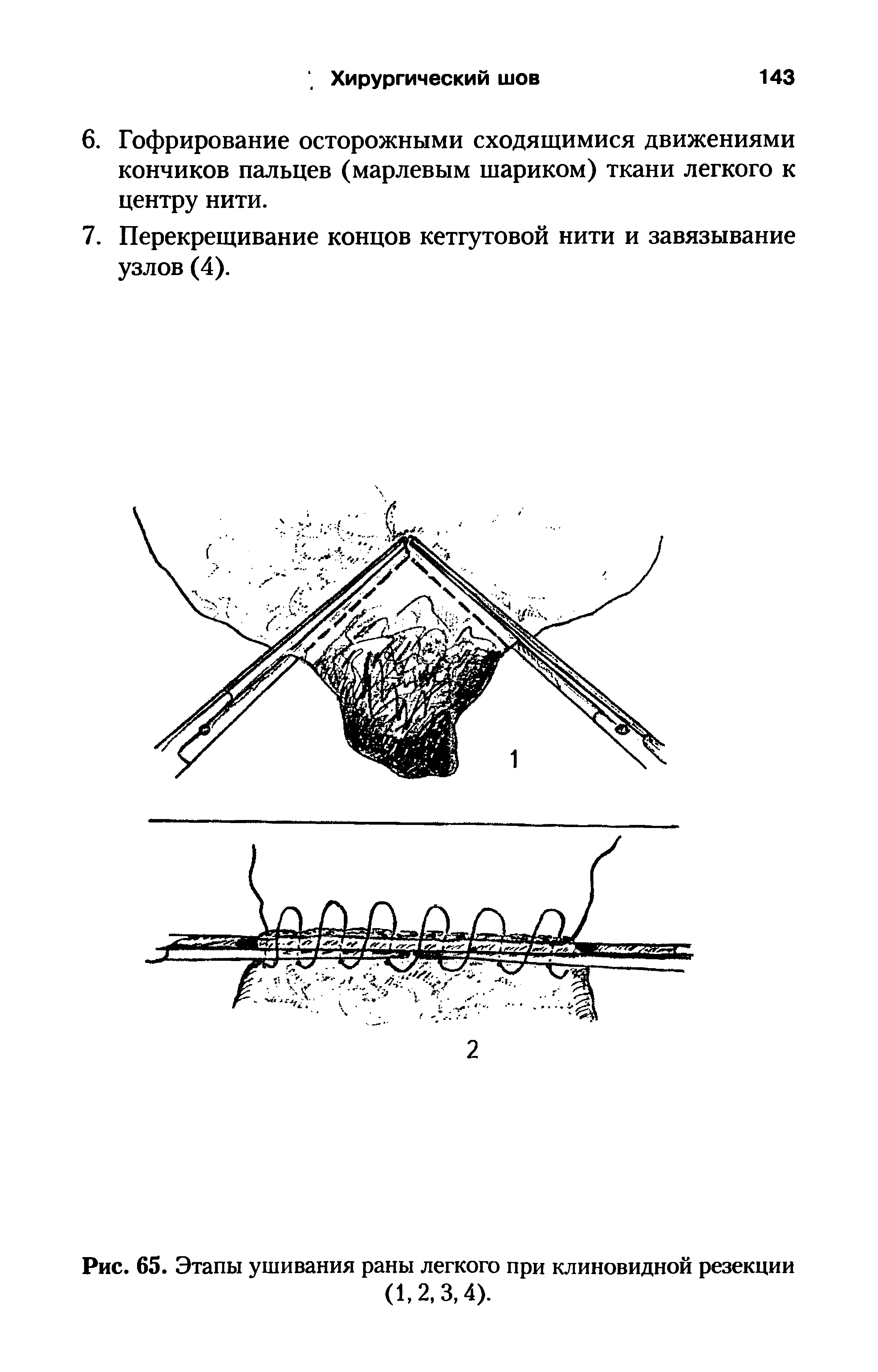 Рис. 65. Этапы ушивания раны легкого при клиновидной резекции (1,2, 3,4).