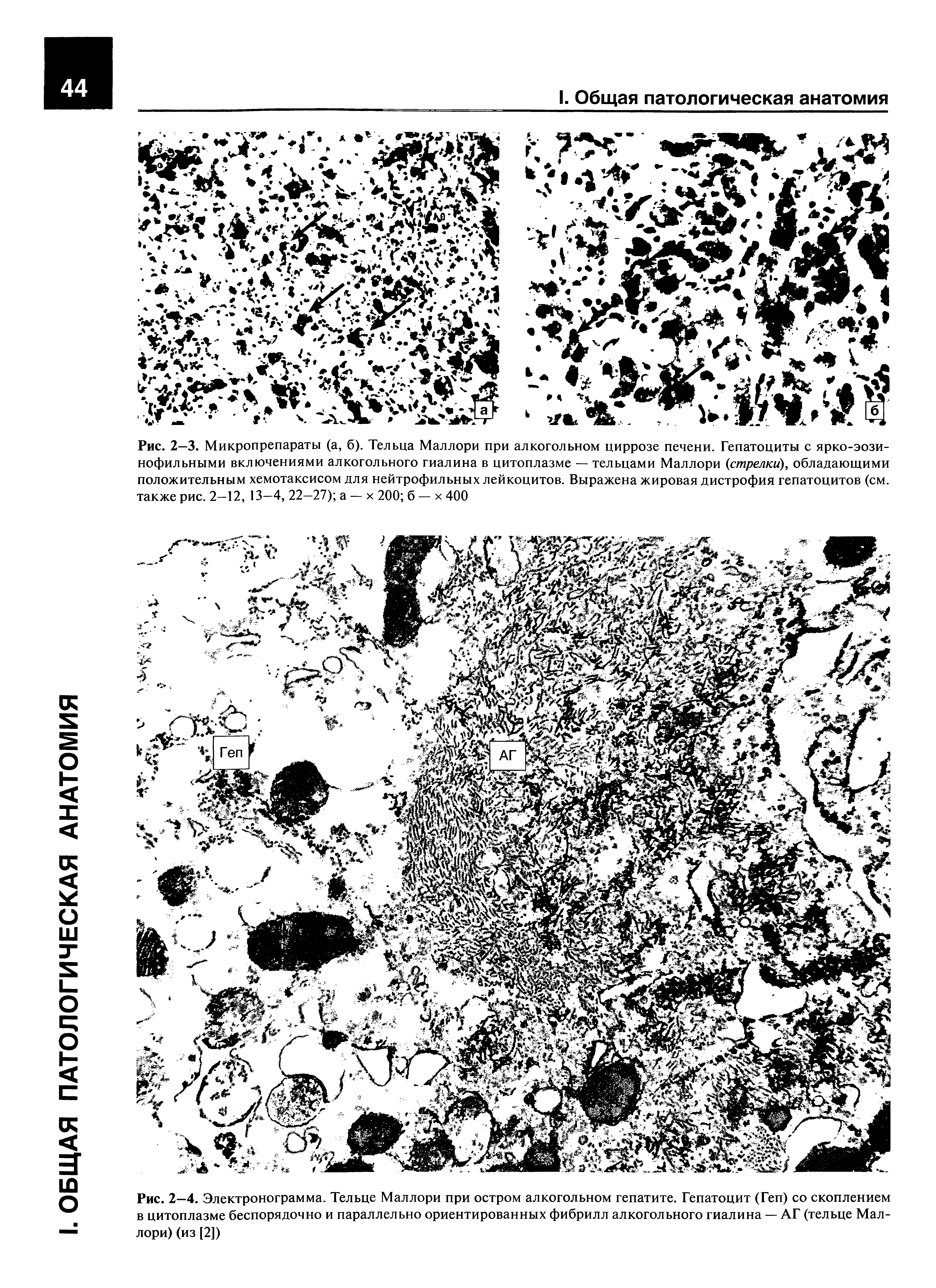 Рис. 2—4. Электронограмма. Тельце Маллори при остром алкогольном гепатите. Гепатоцит (Геп) со скоплением в цитоплазме беспорядочно и параллельно ориентированных фибрилл алкогольного гиалина — АГ (тельце Маллори) (из [2])...