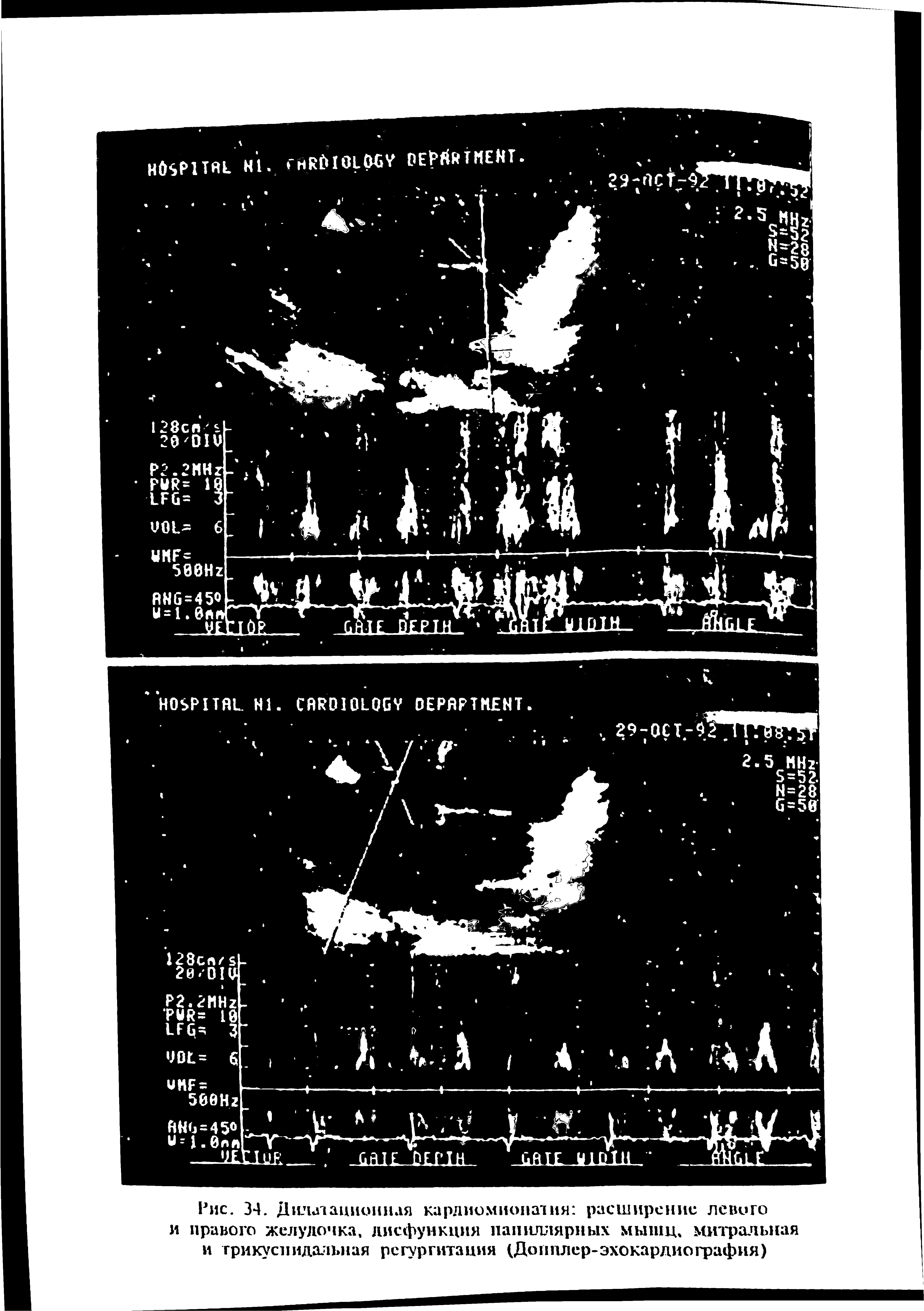 Рис. 34. Дилл анионная кардиомиопатия расширение левого и правого желудочка, дисфункция папиллярных мышц, митральная и трикуспидальная регургитация (Допплер-эхокардиография)...