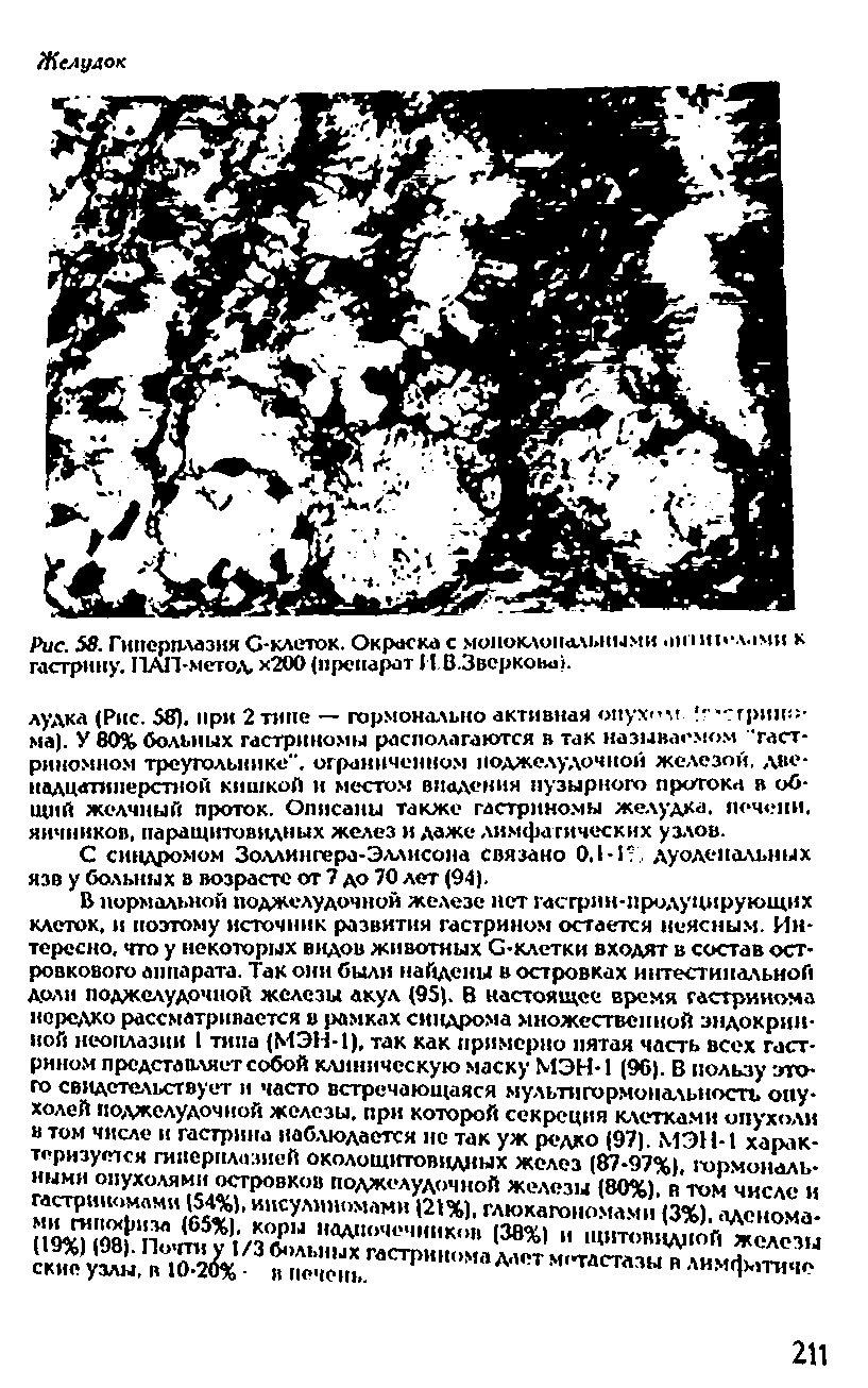 Рис. 58. Гиперплазия С-клеток. Окраска с моноклональными. но-лами к гастрину. ПАП-метод, х200 (препарат 11 В.3верков 1>.