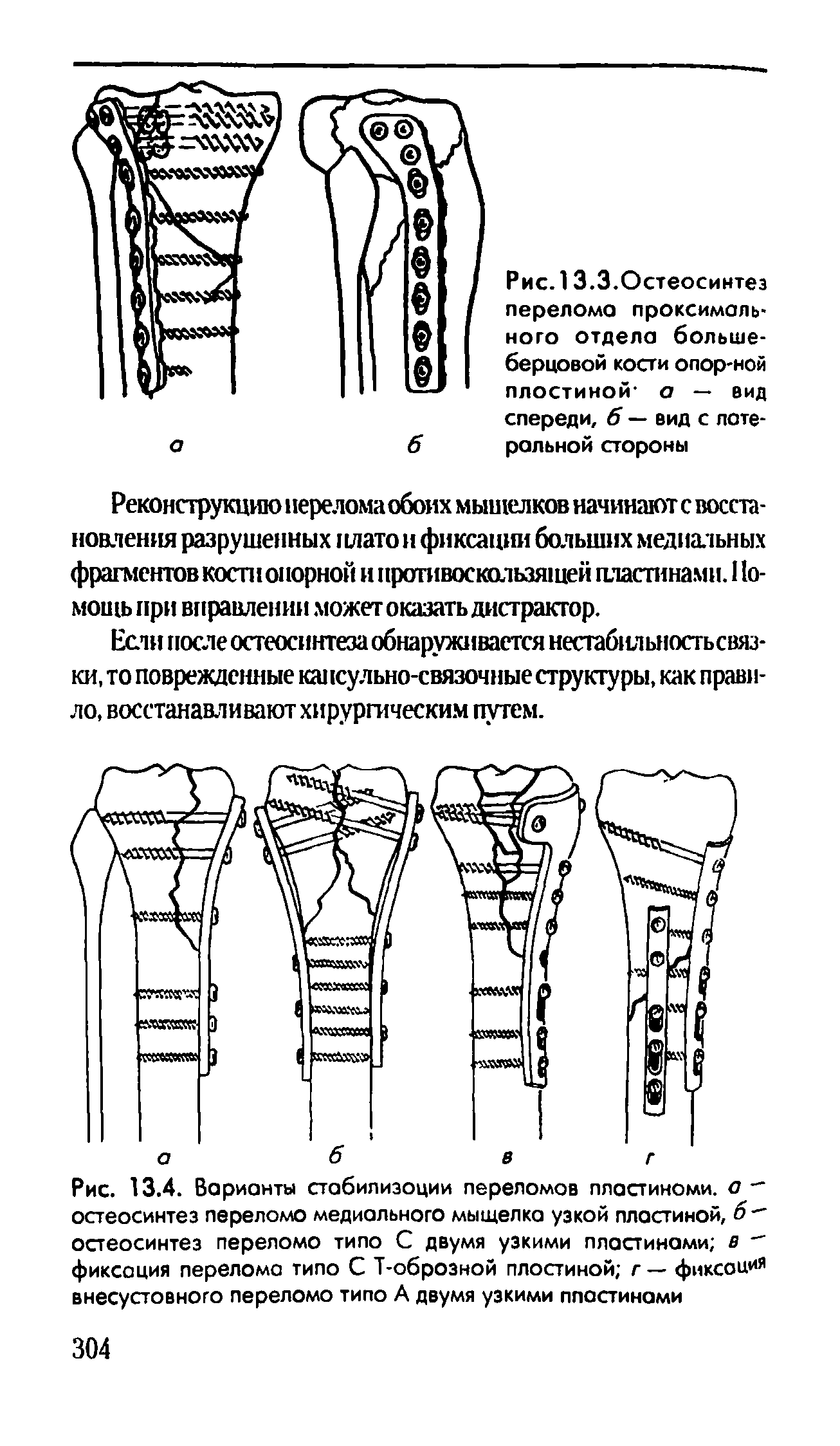 Рис. 13.3.Остеосинтез перелома проксимального отдела большеберцовой кости опор-ной плостиной- а — вид спереди, б — вид с латеральной стороны...