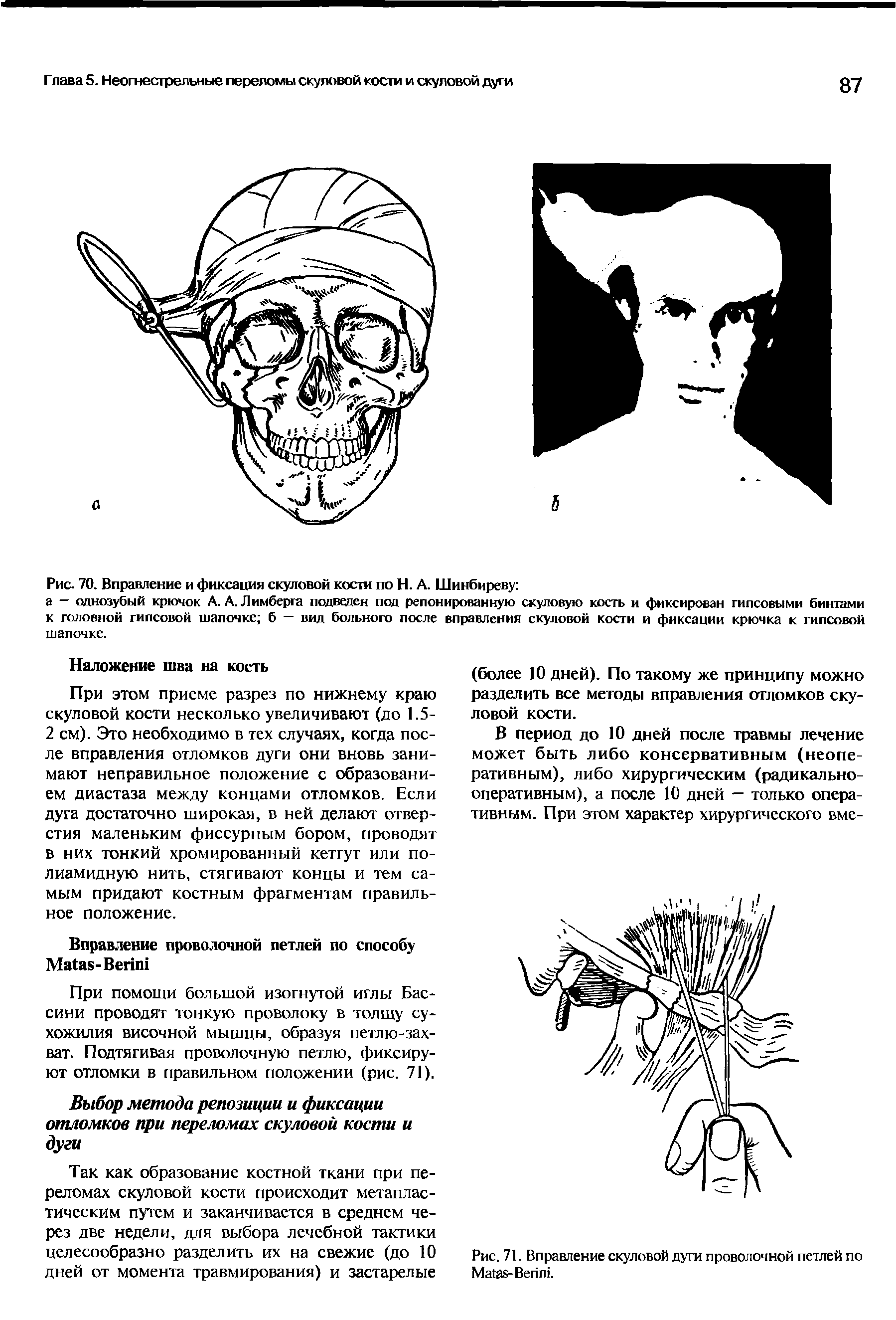 Рис. 71. Вправление скуловой дуги проволочной петлей по M - B .