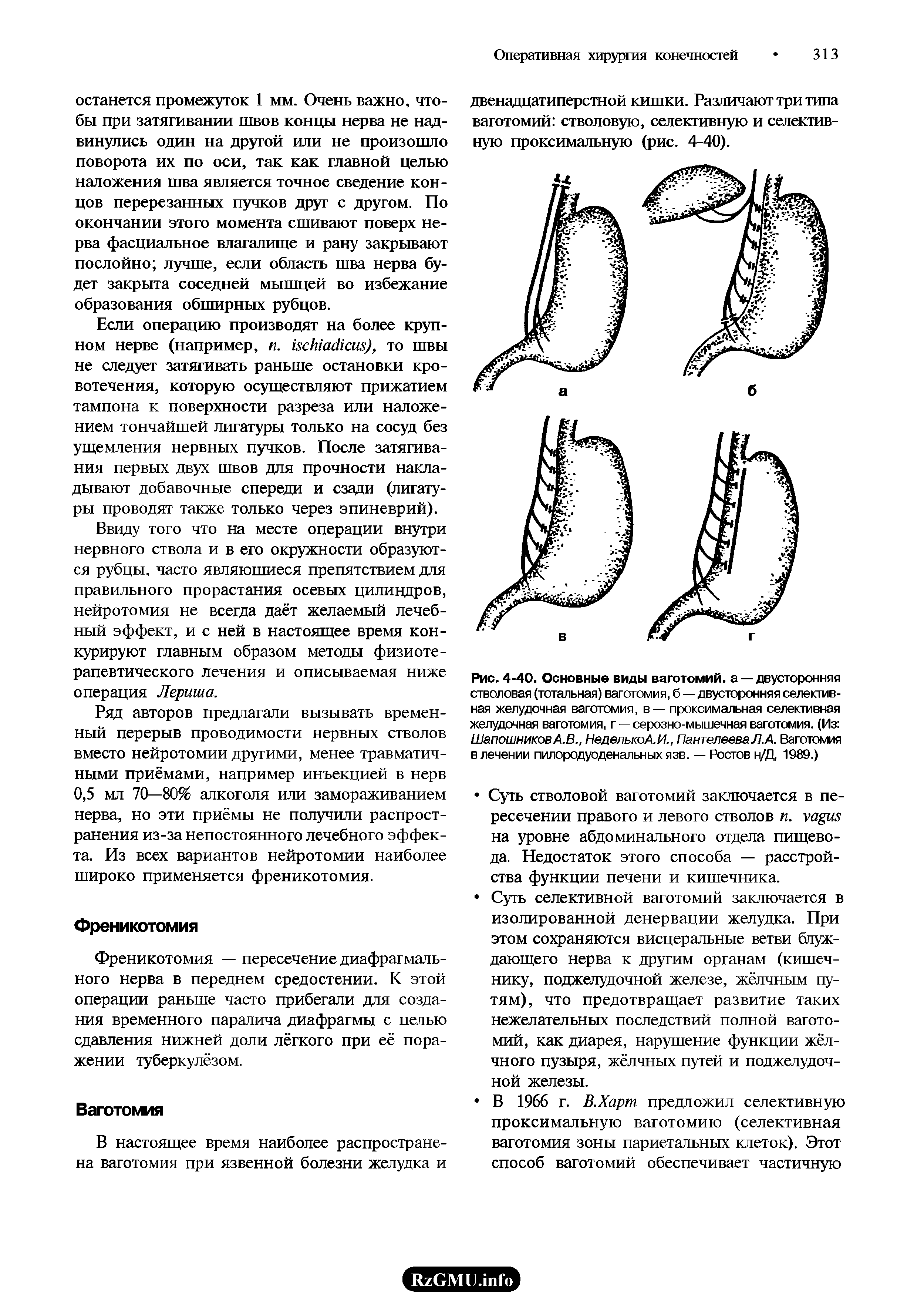 Рис. 4-40. Основные виды ваготомий, а — двусторонняя стволовая (тотальная) ваготомия, б — двусторонняя селективная желудочная ваготомия, в — проксимальная селективная желудочная ваготомия, г —серозно-мышечная ваготомия. (Из ШапошниковА.В., НеделькоА.И., ПантелееваЛ.А. Ваготомия влечении пилородуоденальныхязв. — Ростов н/Д, 1989.)...