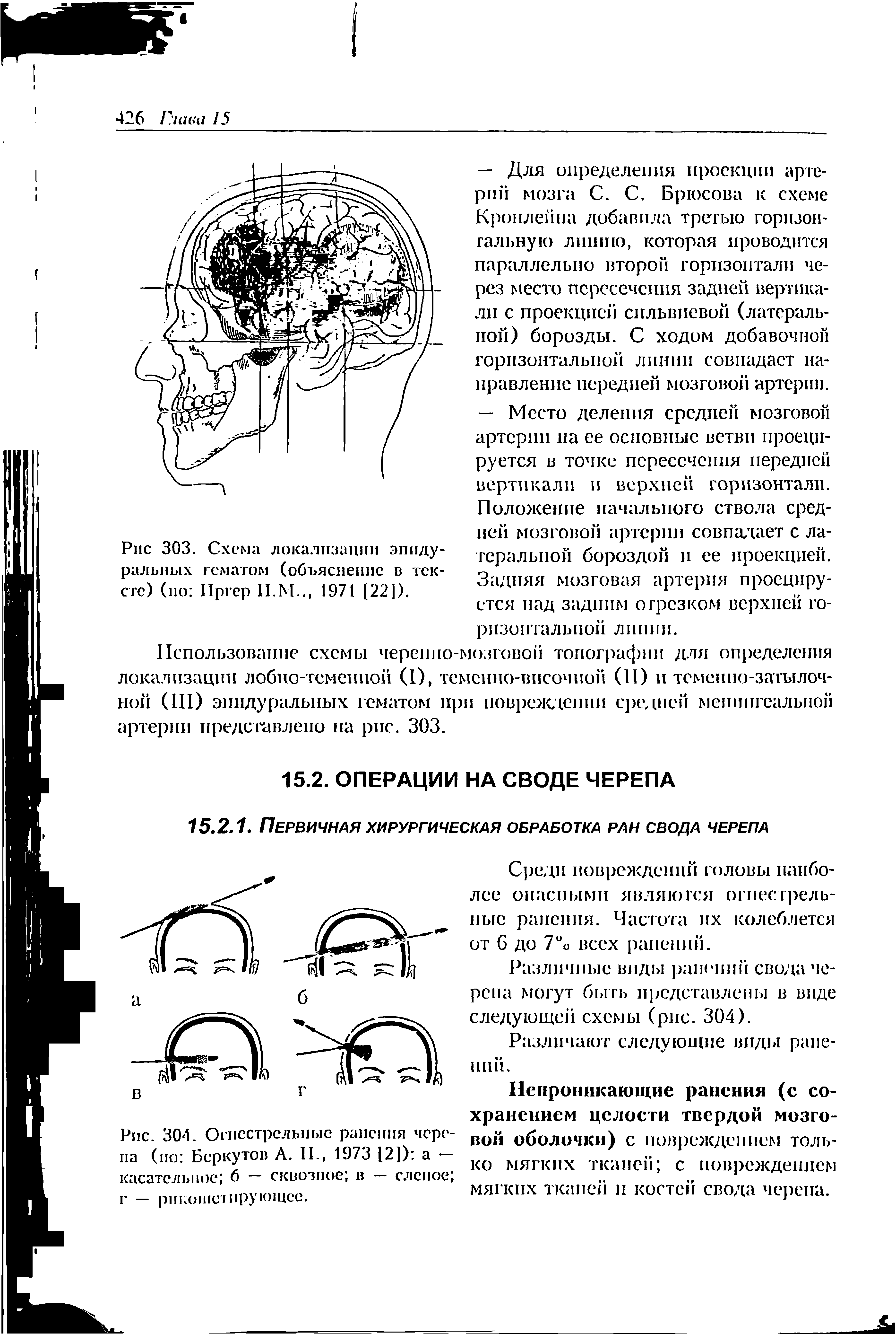 Рис. 304. Огнестрельные ранения черепа (ио Беркутов А. II., 1973 12]) а — касательное 6 — сквозное в — слепое г — рикошетирующее.