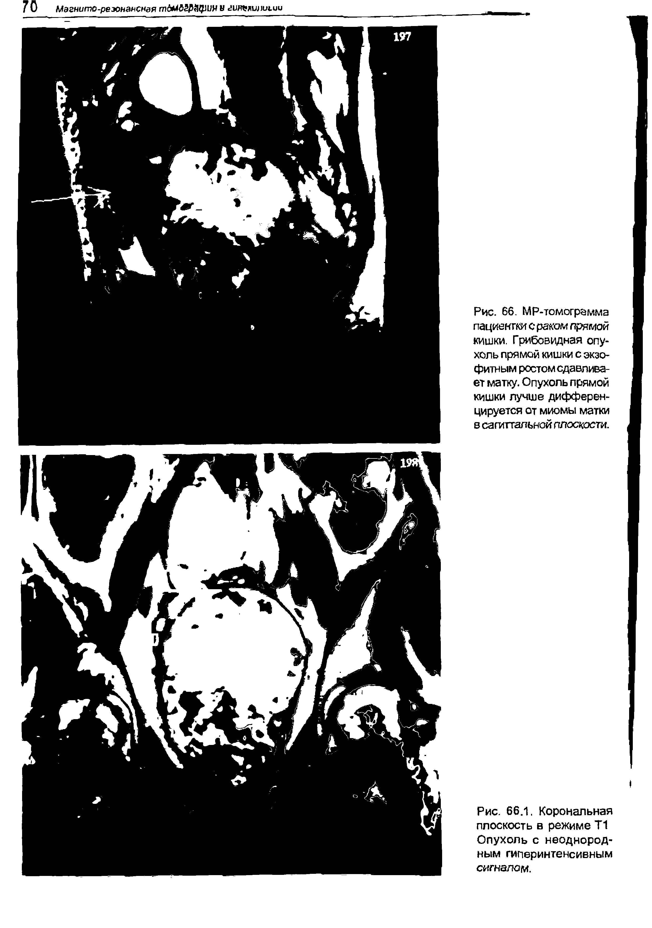 Рис. 66. МР-томограмма пациентки с раком прямой кишки. Грибовидная опухоль прямой кишки с экзофитным ростом сдавливает матку. Опухоль прямой кишки лучше дифференцируется от миомы матки в сагиттальной плоскости.